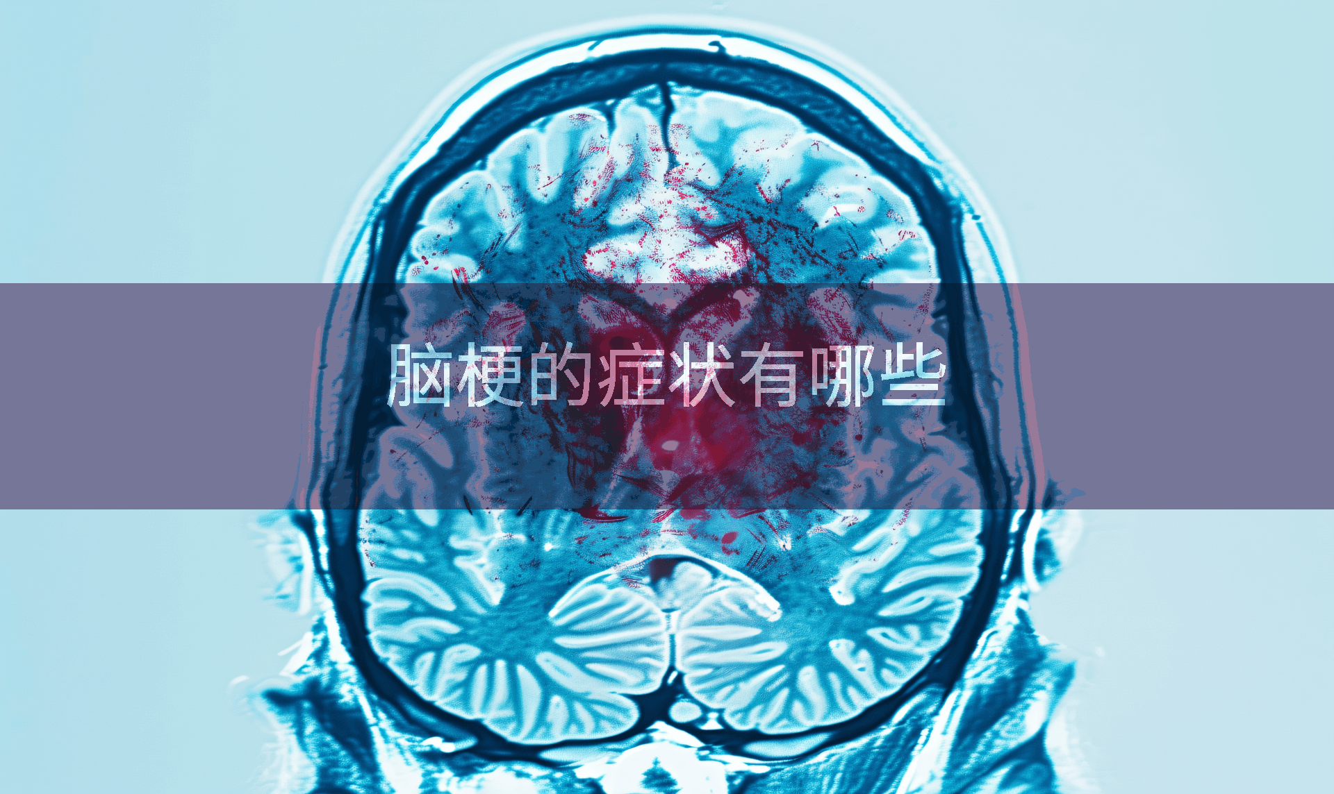 脑梗的症状有哪些