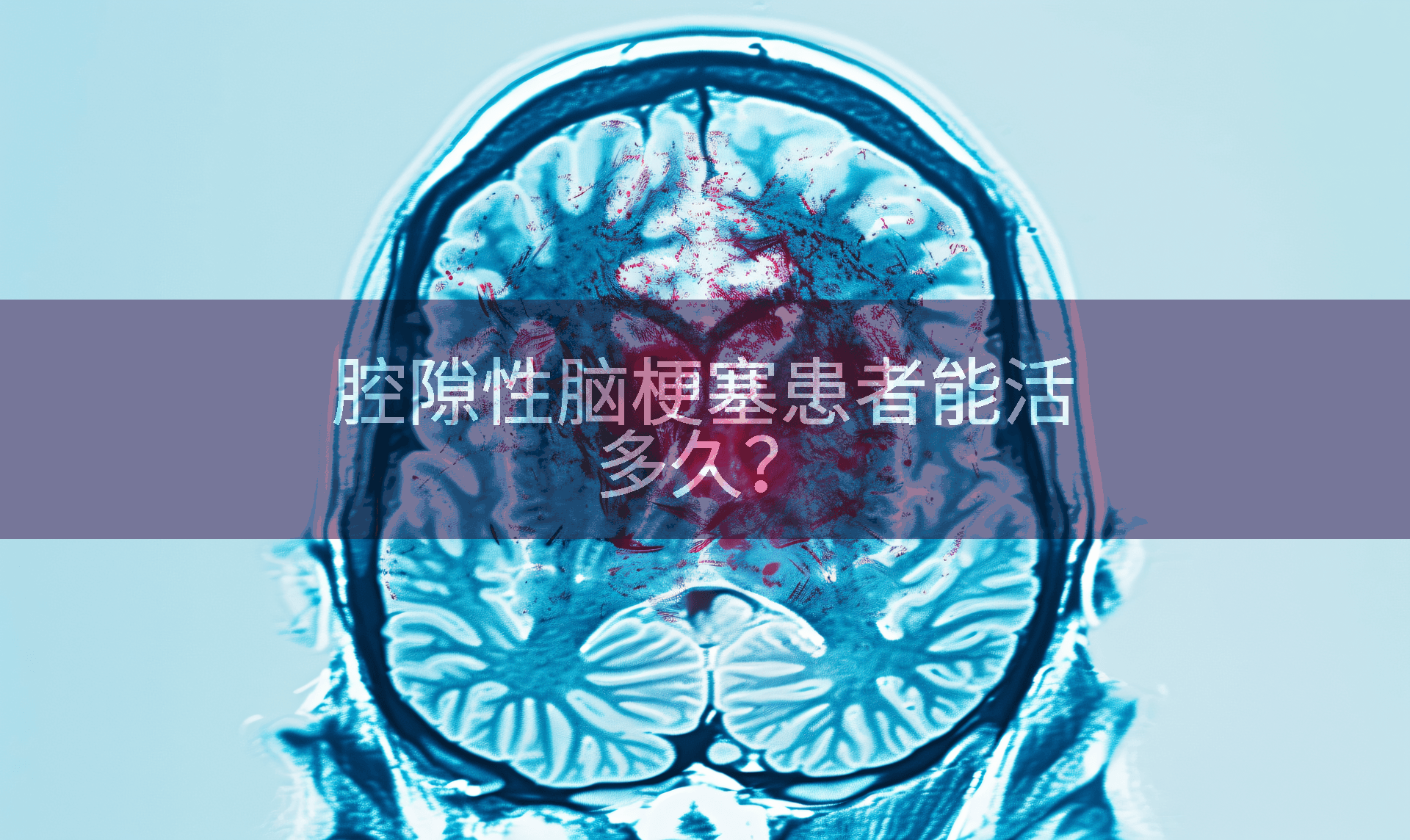 腔隙性脑梗塞患者能活多久？