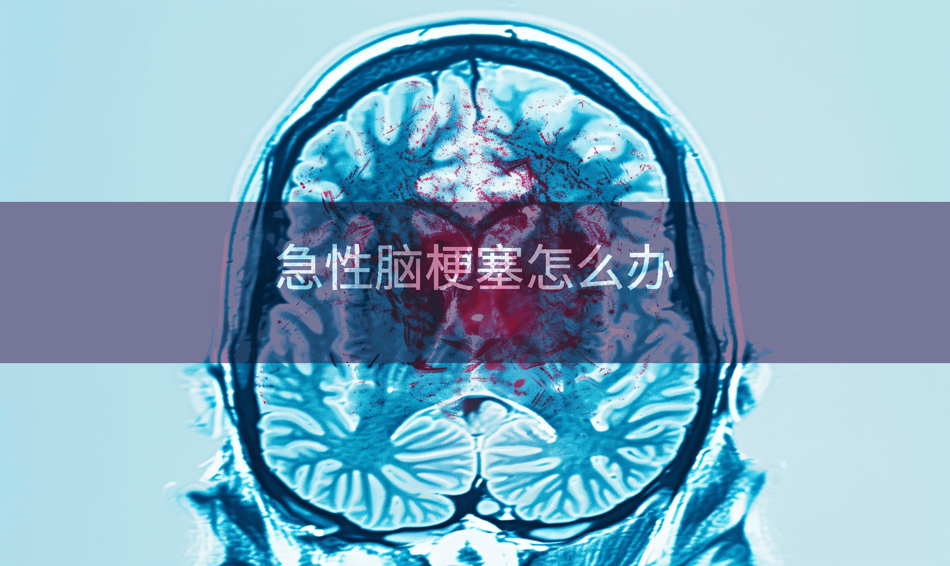 急性脑梗塞怎么办