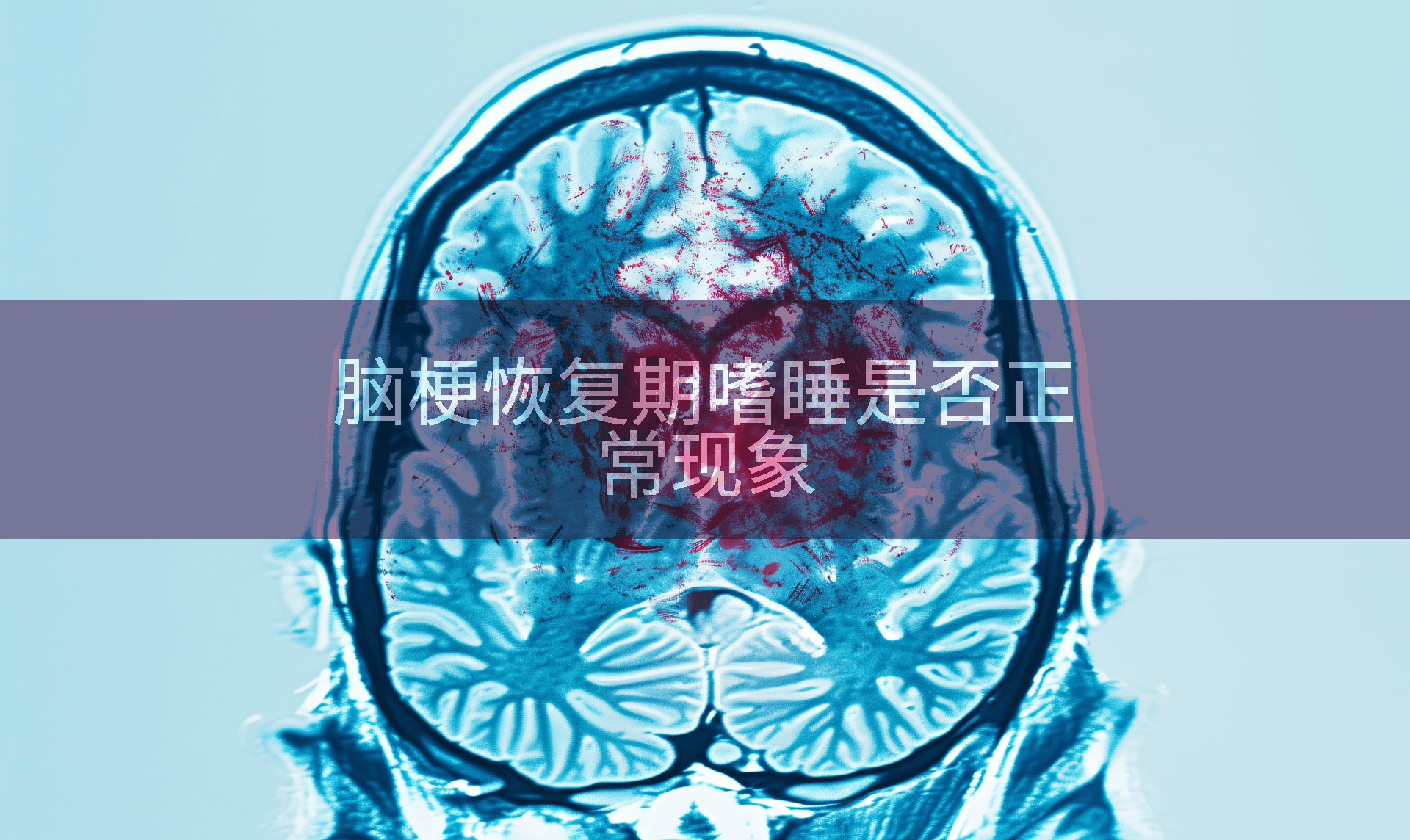 脑梗恢复期嗜睡是否正常现象
