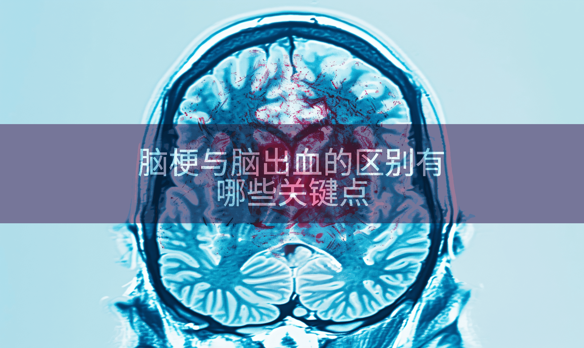 脑梗与脑出血的区别有哪些关键点