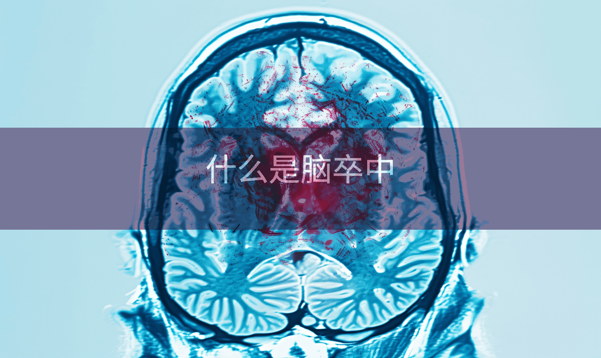 什么是脑卒中