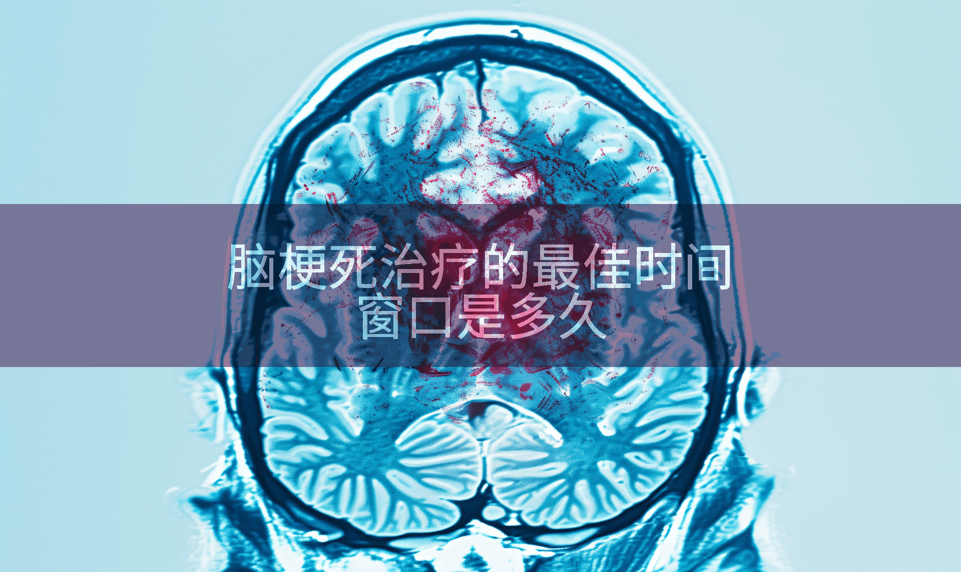 脑梗死治疗的最佳时间窗口是多久