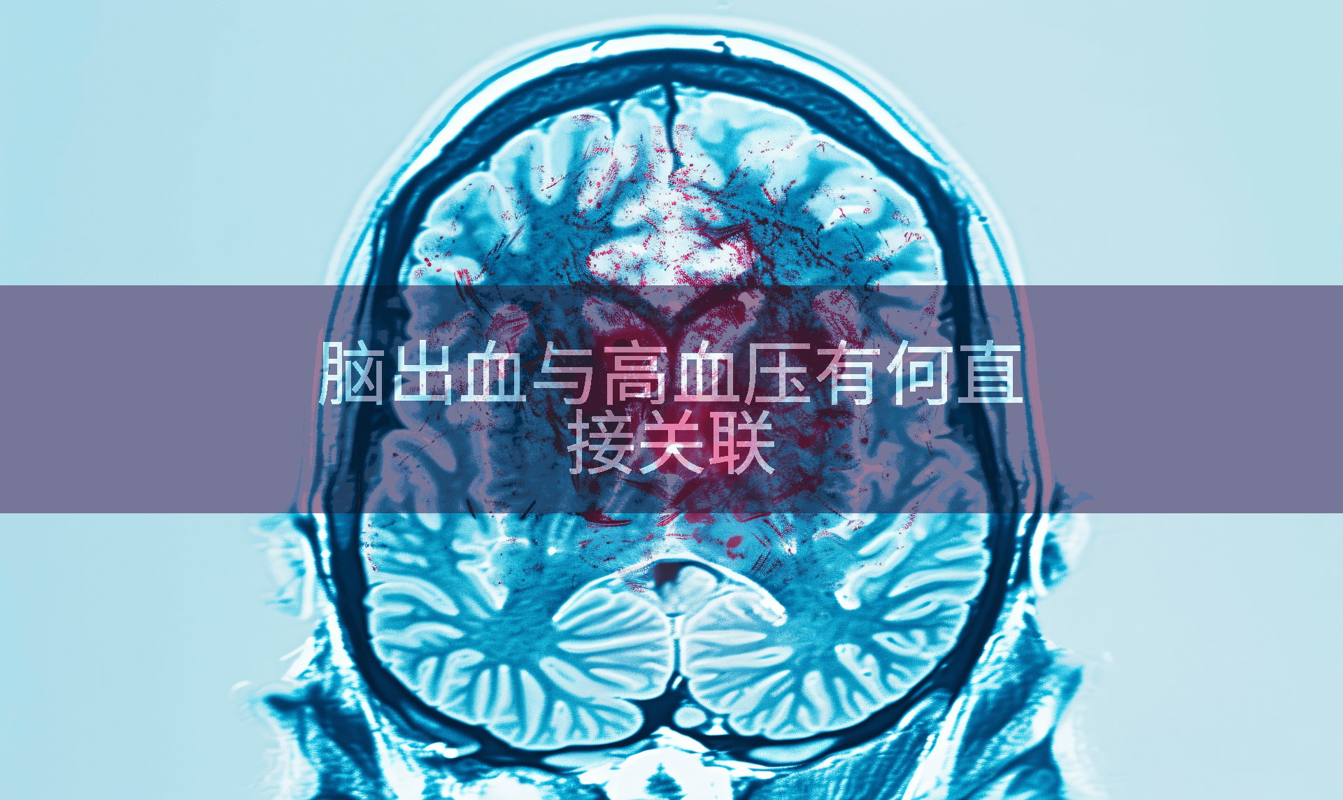 脑出血与高血压有何直接关联