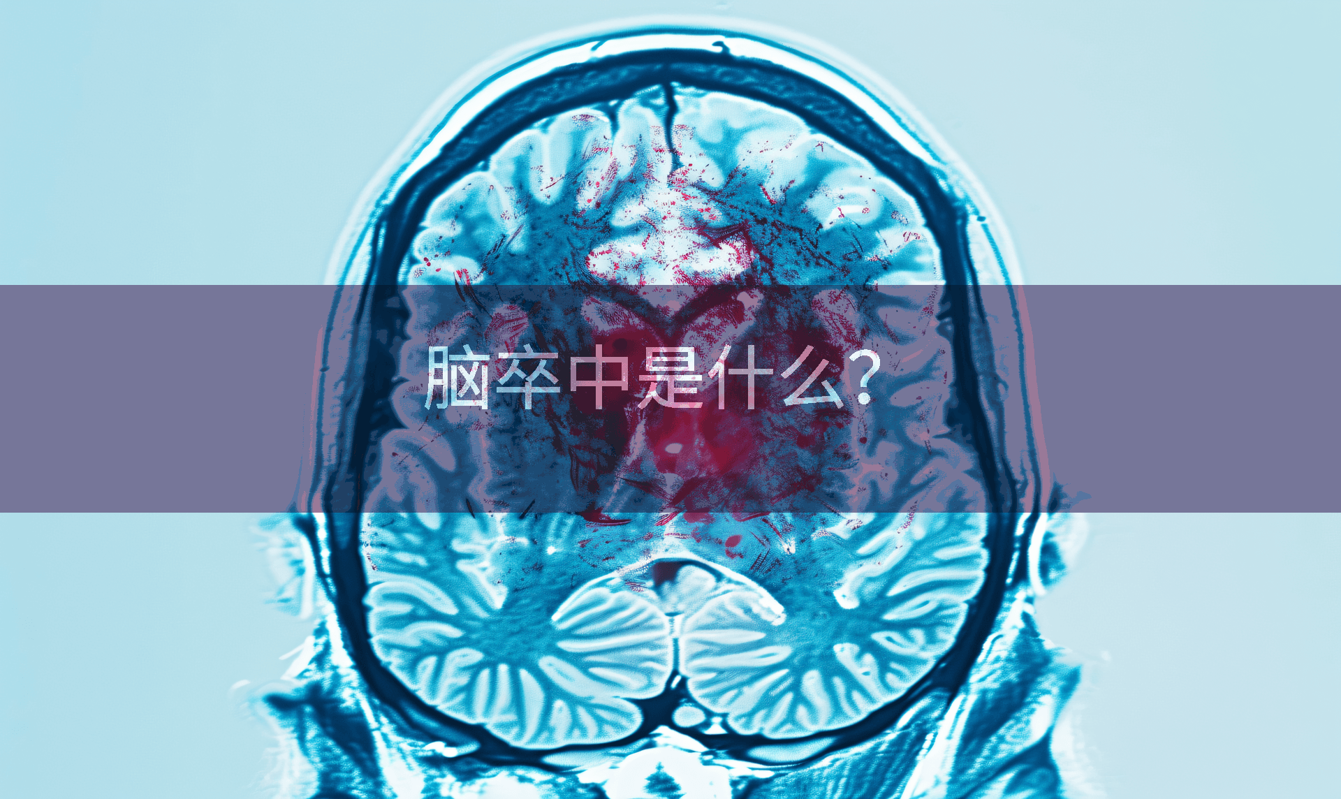 脑卒中是什么？