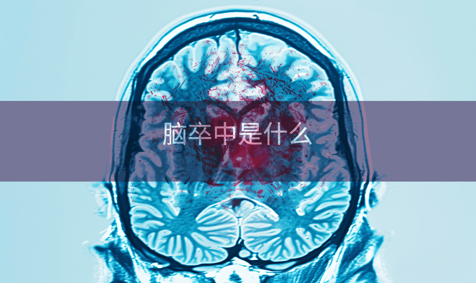 脑卒中是什么
