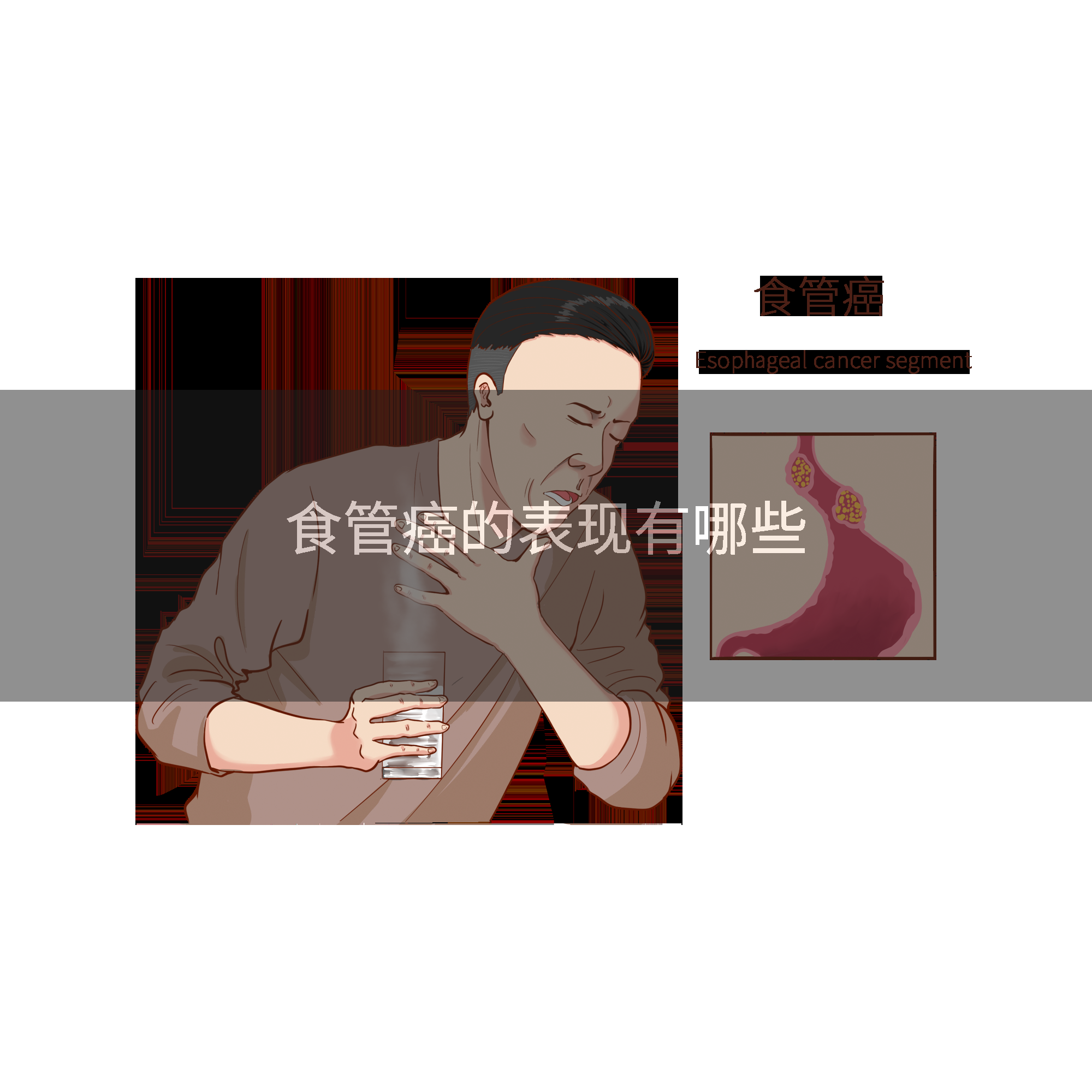 食管癌的表现有哪些
