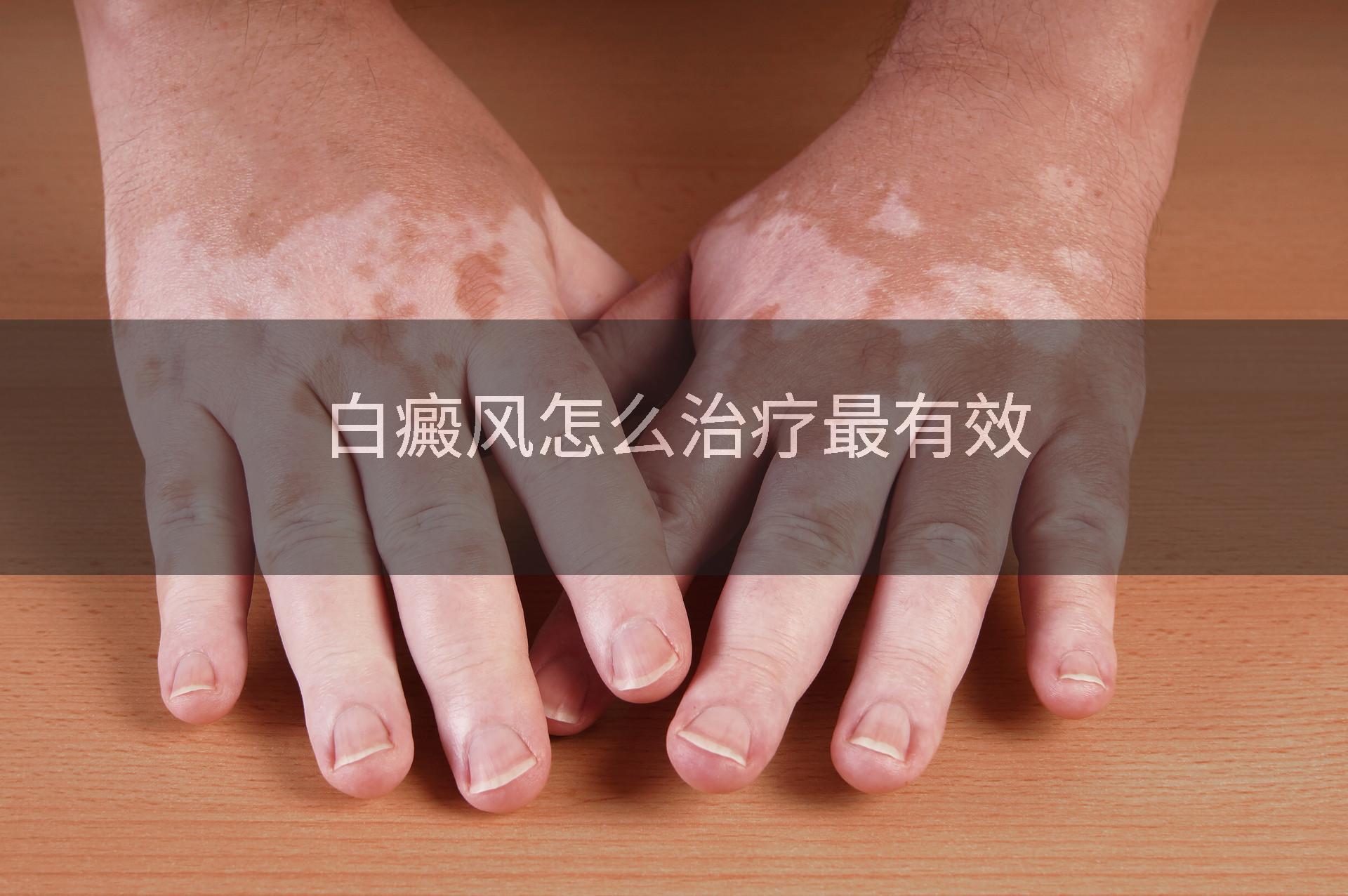白癜风怎么治疗最有效