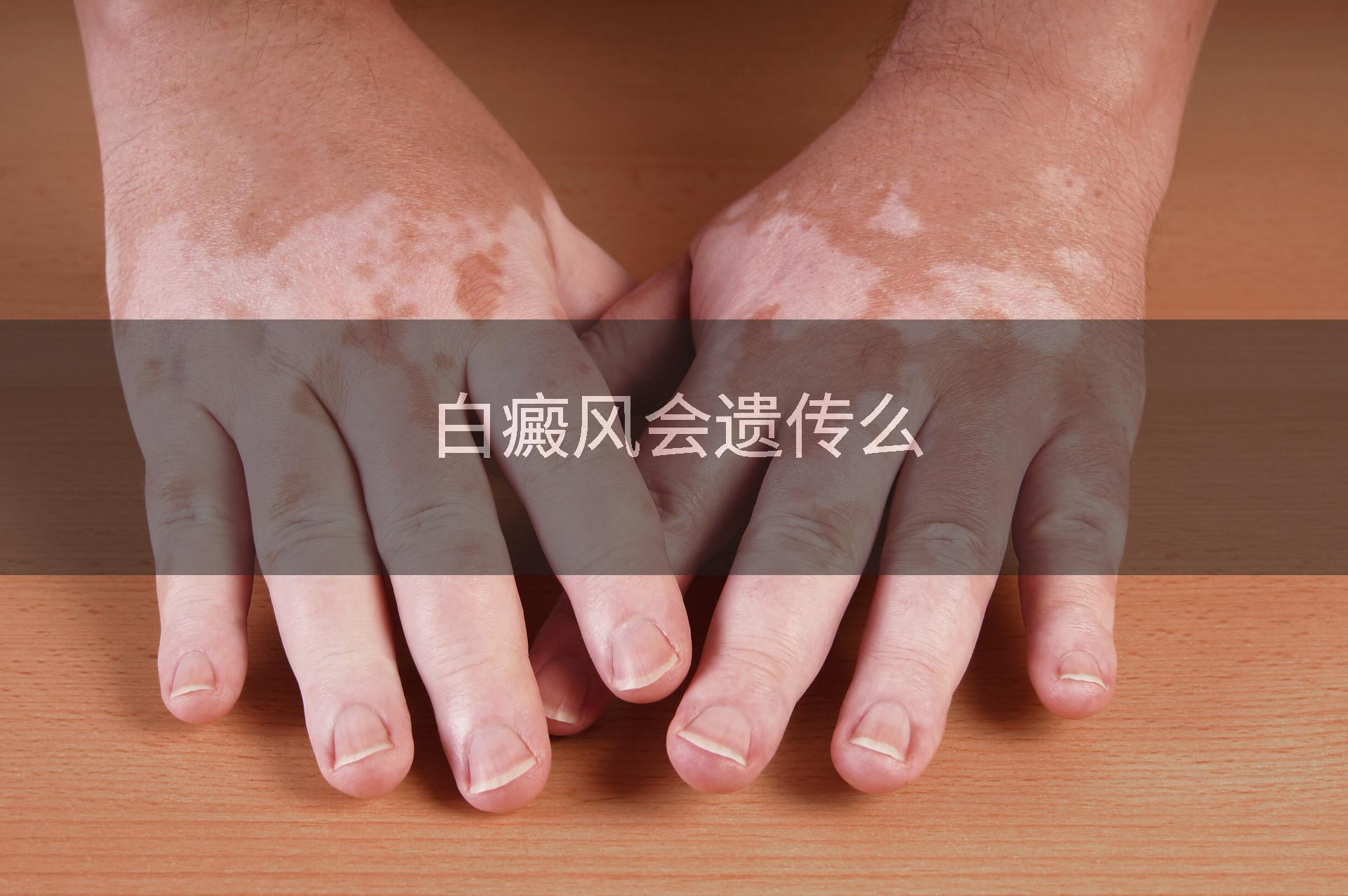 白癜风会遗传么