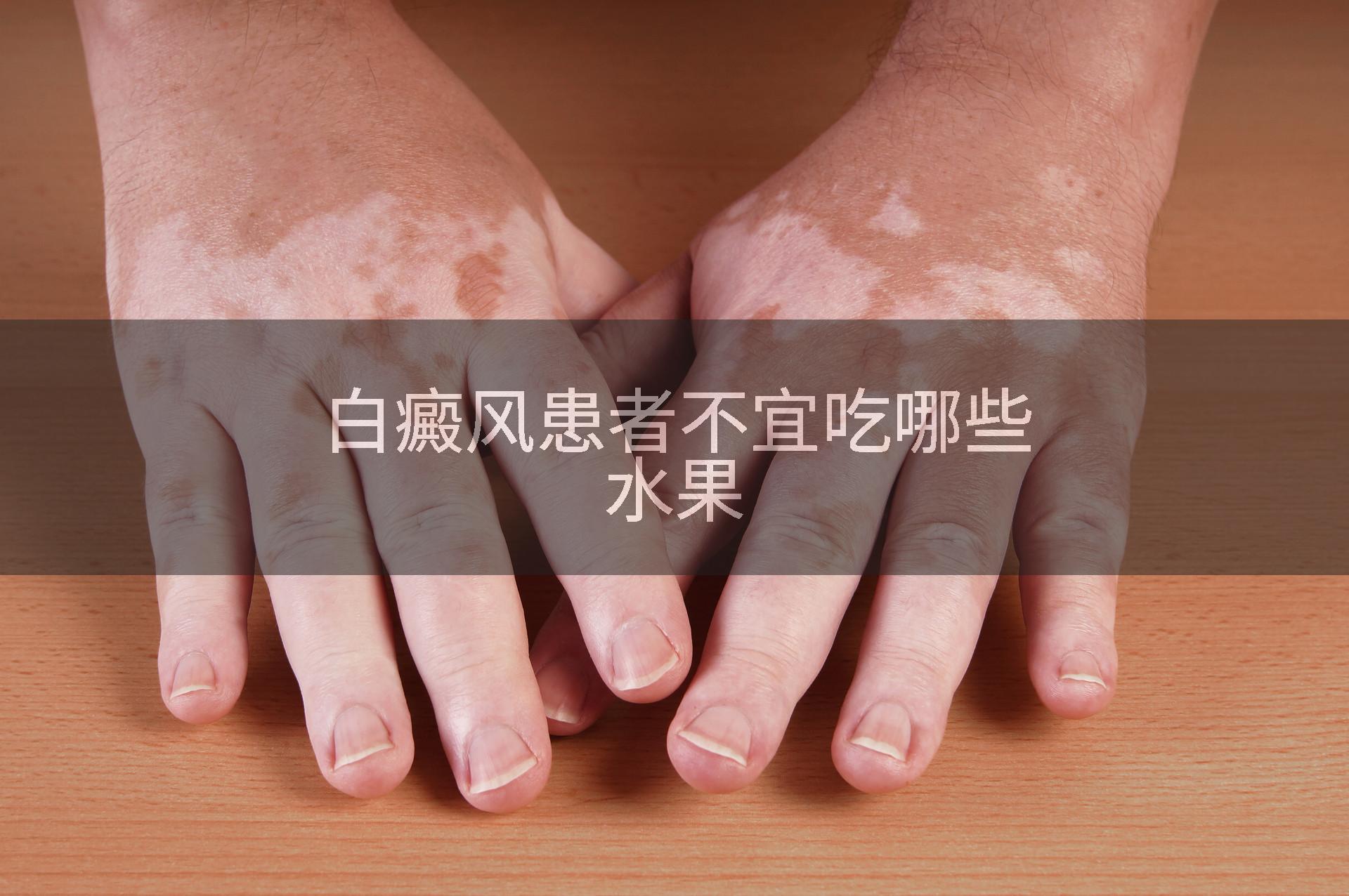白癜风患者不宜吃哪些水果