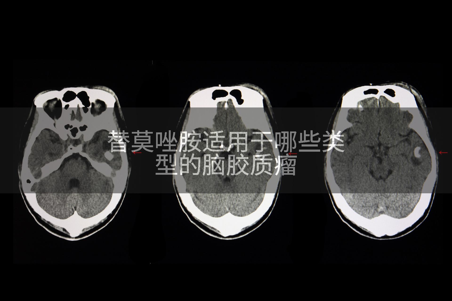 替莫唑胺适用于哪些类型的脑胶质瘤