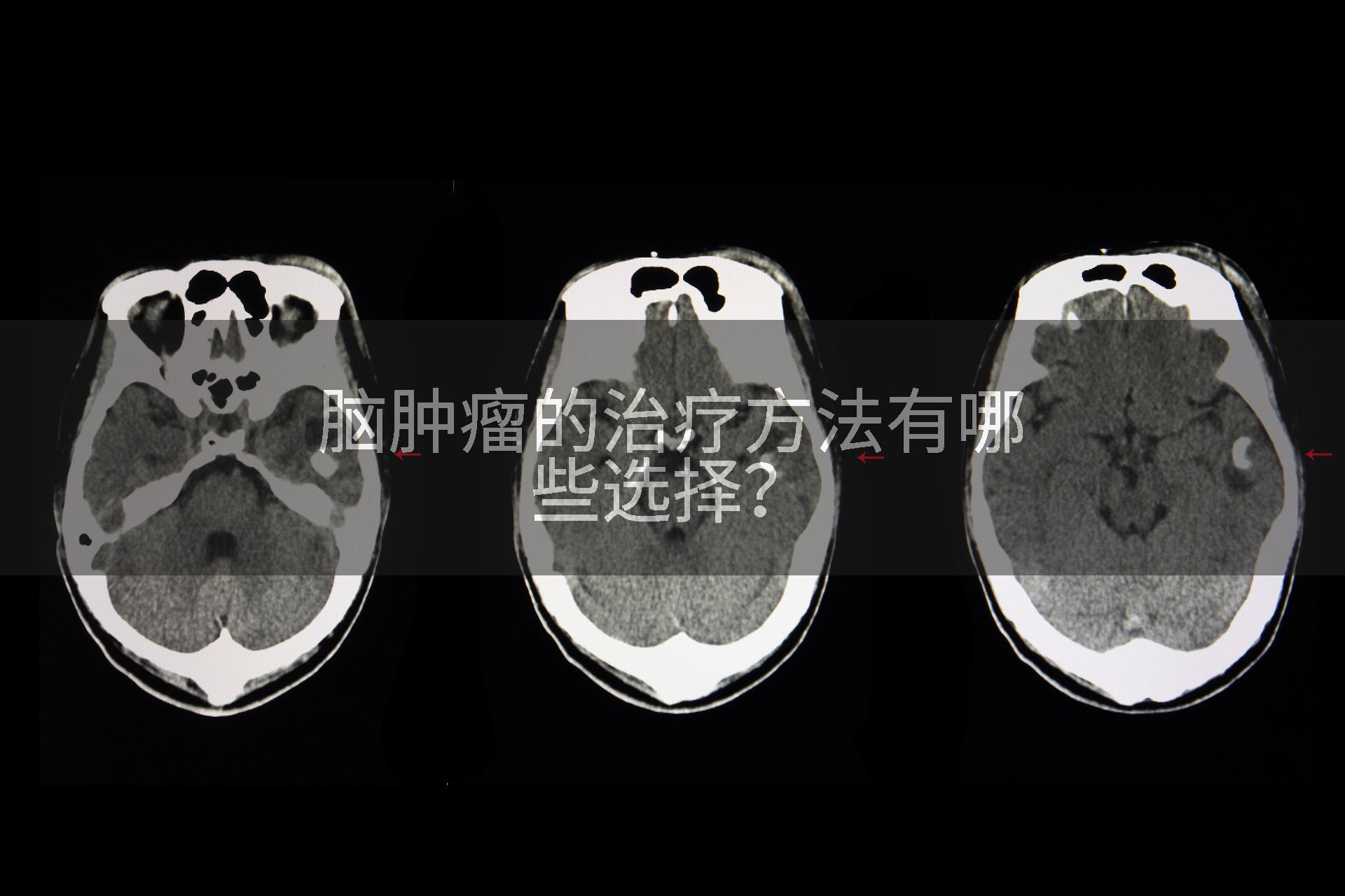 脑肿瘤的治疗方法有哪些选择？