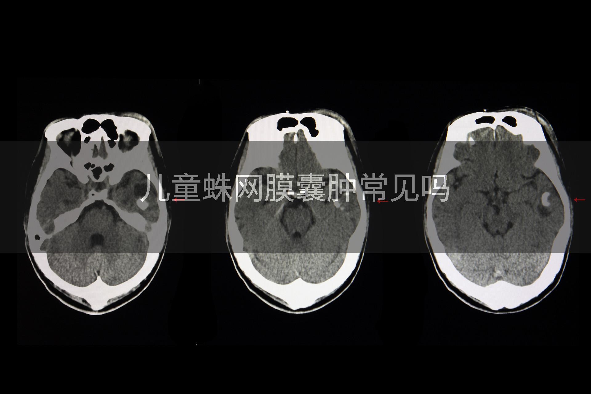 儿童蛛网膜囊肿常见吗