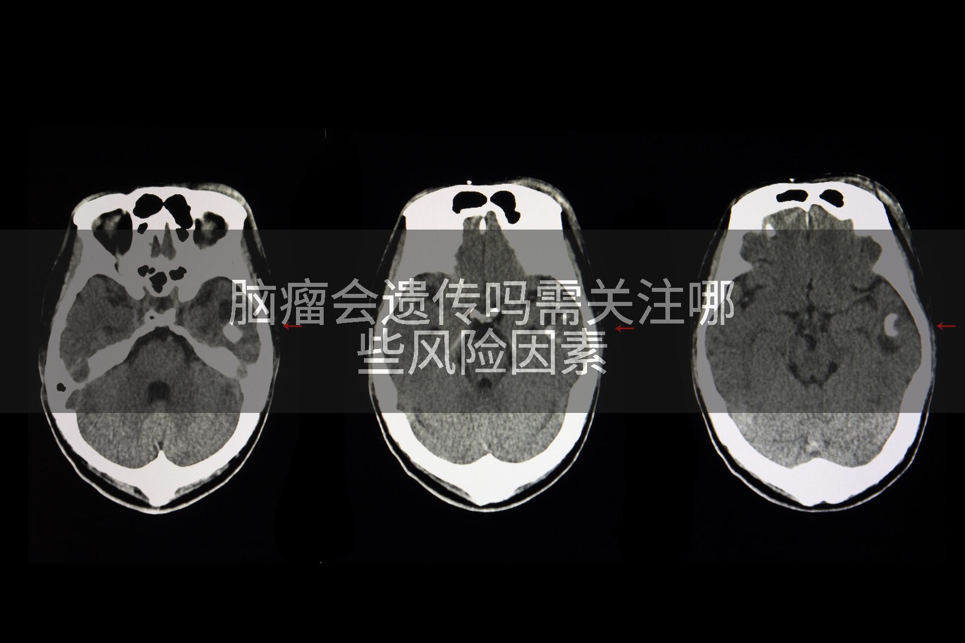 脑瘤会遗传吗需关注哪些风险因素