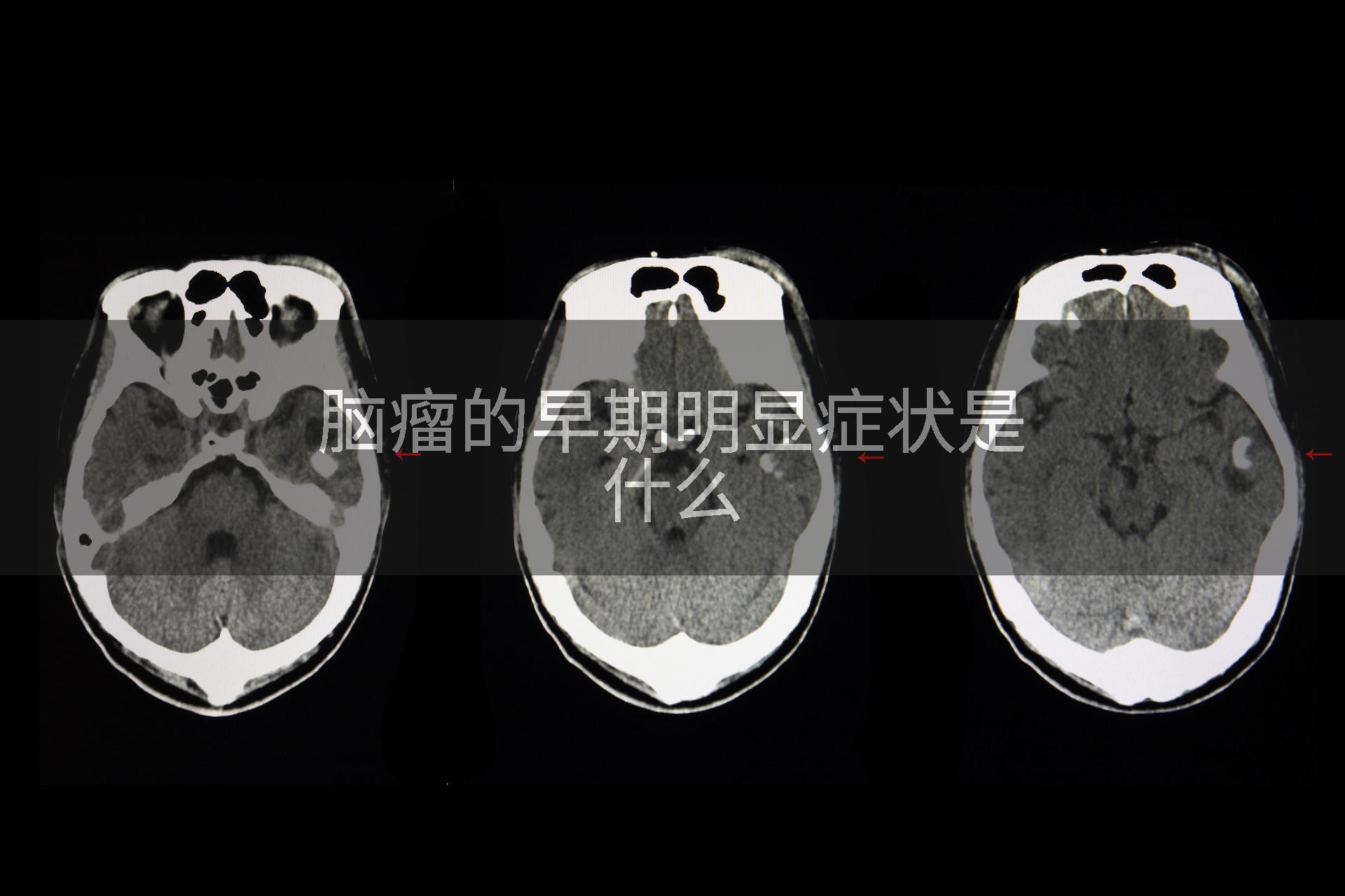 脑瘤的早期明显症状是什么