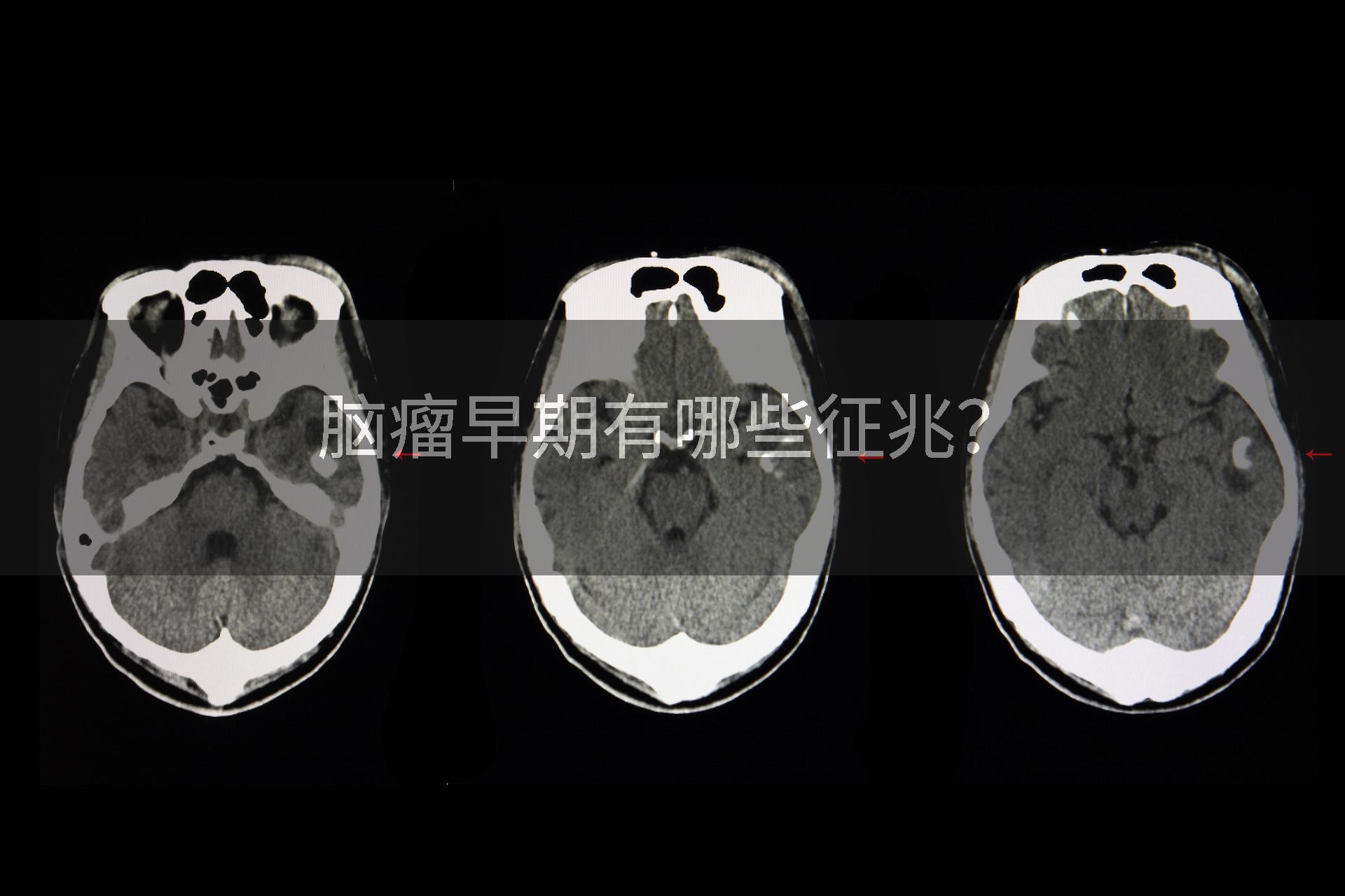 脑瘤早期有哪些征兆？