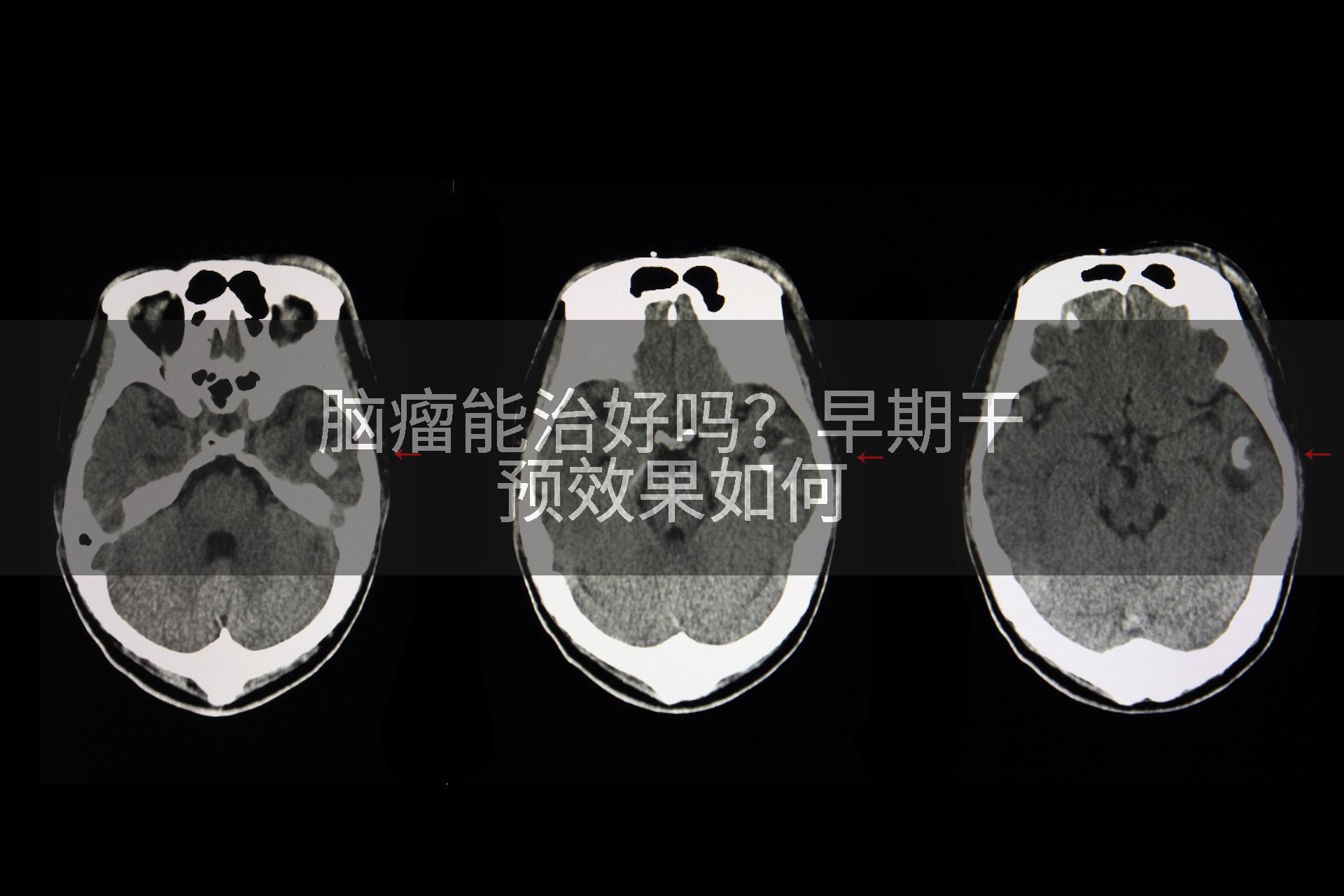 脑瘤能治好吗？早期干预效果如何