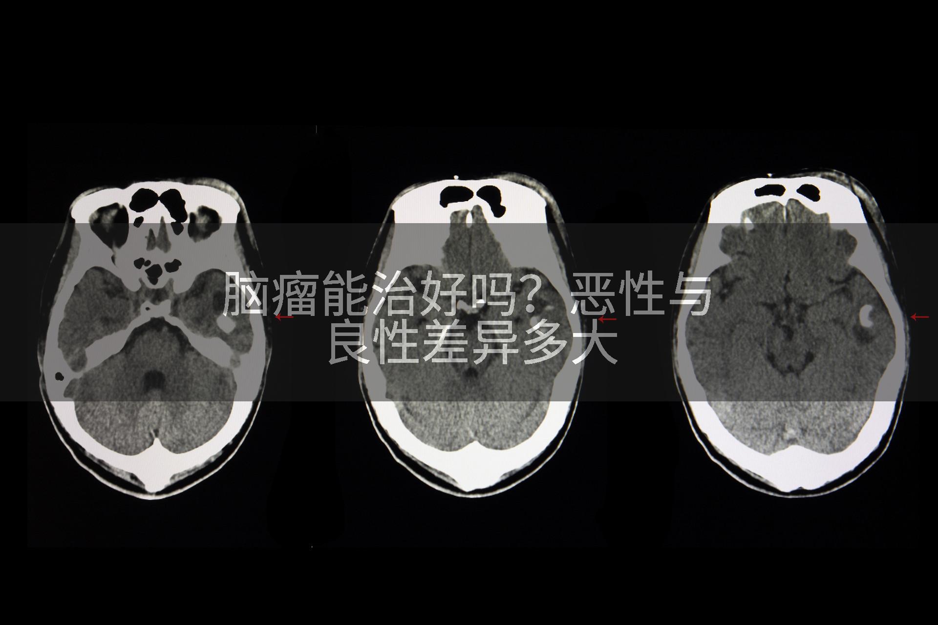 脑瘤能治好吗？恶性与良性差异多大