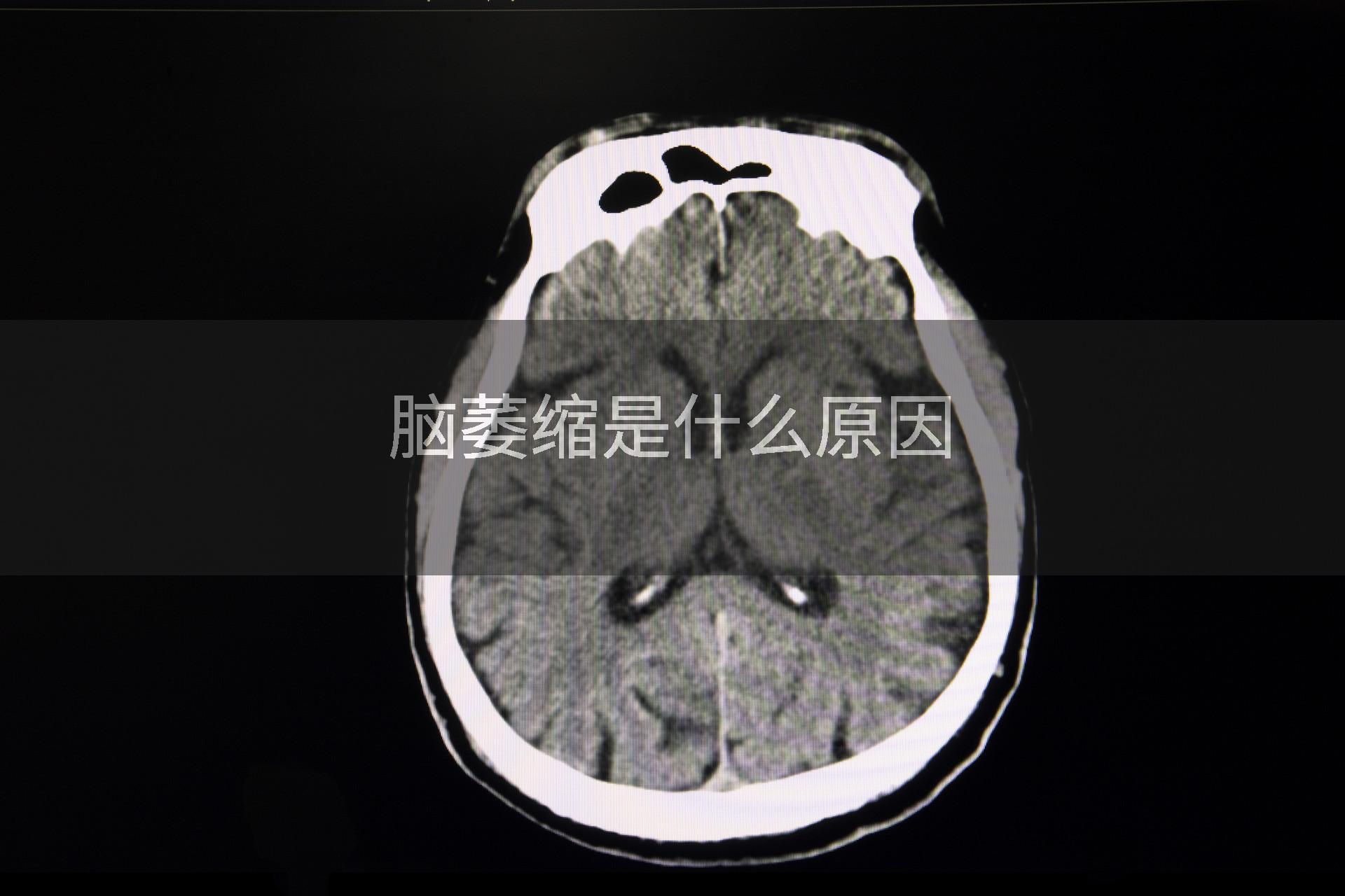 脑萎缩是什么原因