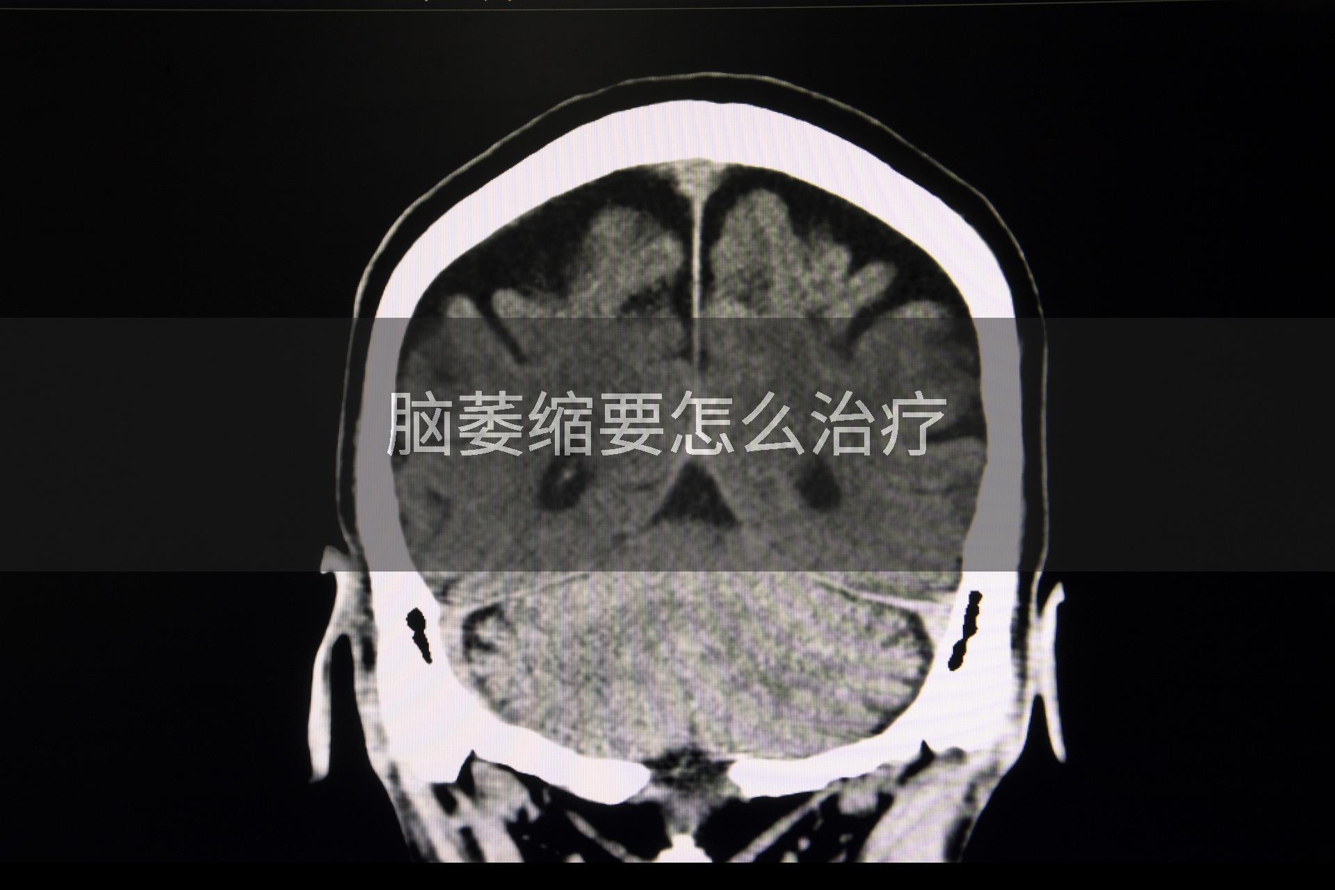 脑萎缩要怎么治疗