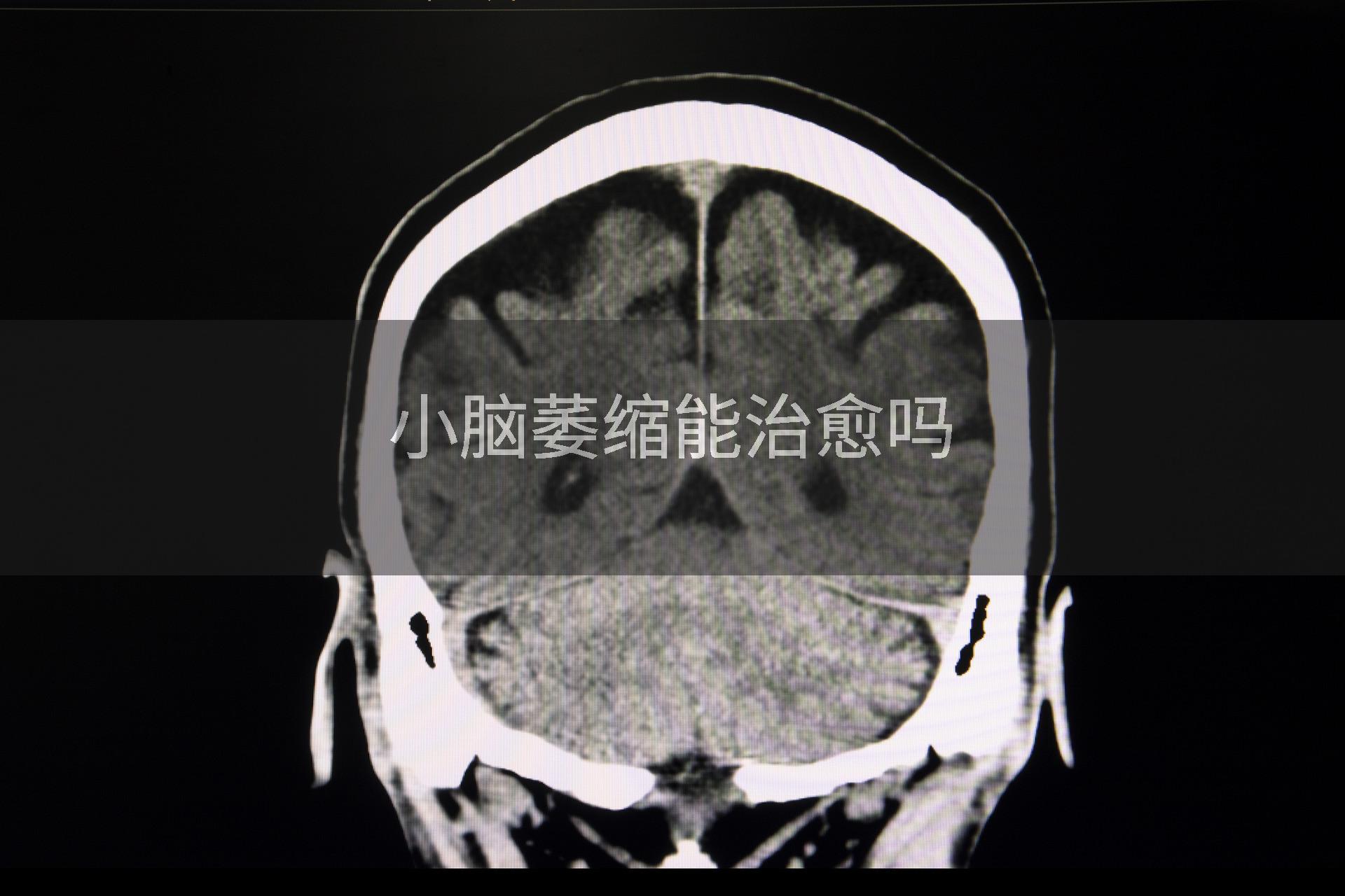 小脑萎缩能治愈吗