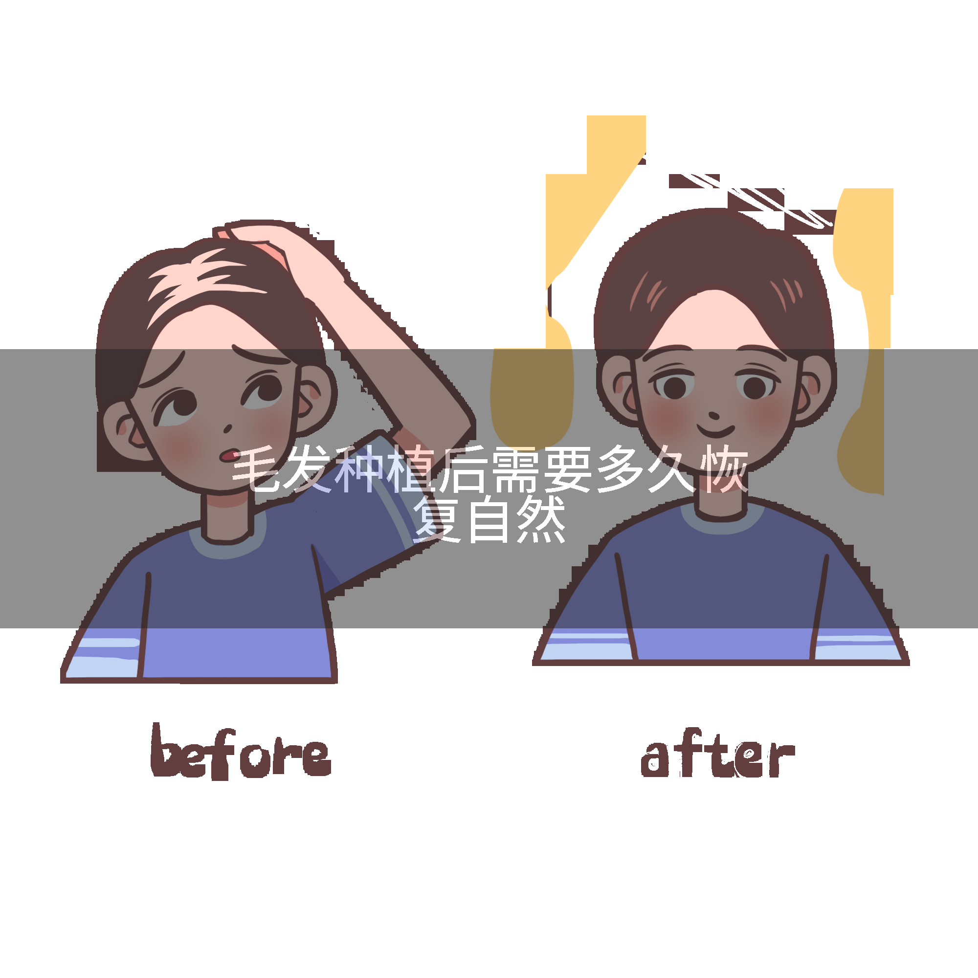 毛发种植后需要多久恢复自然