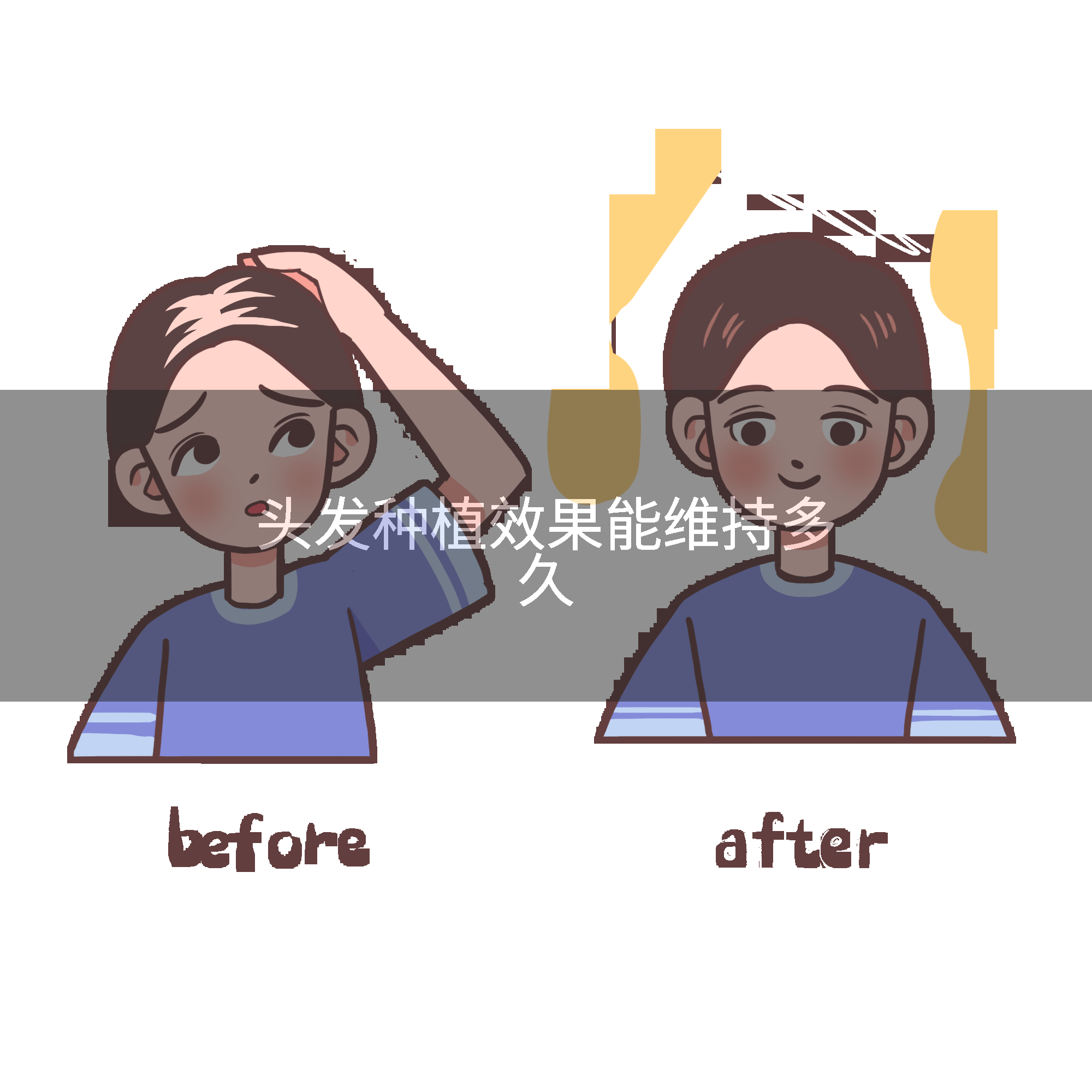 头发种植效果能维持多久