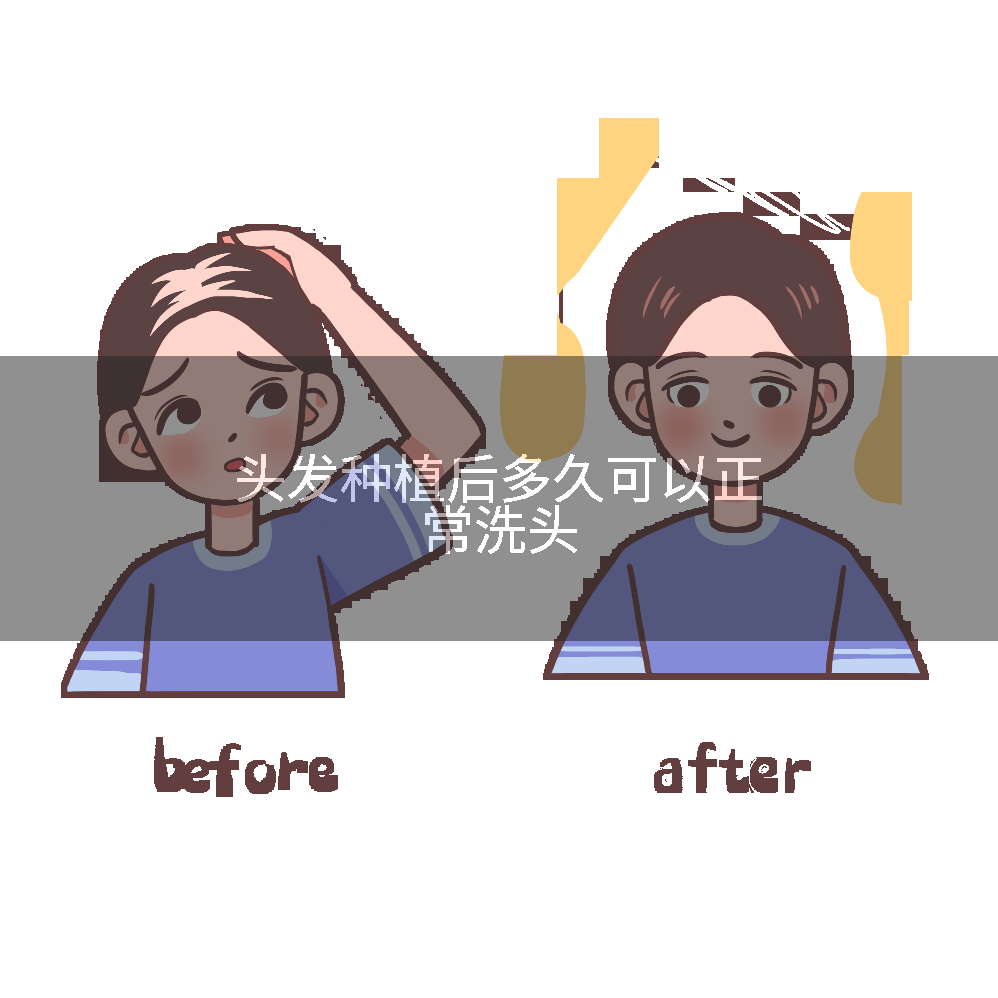 头发种植后多久可以正常洗头