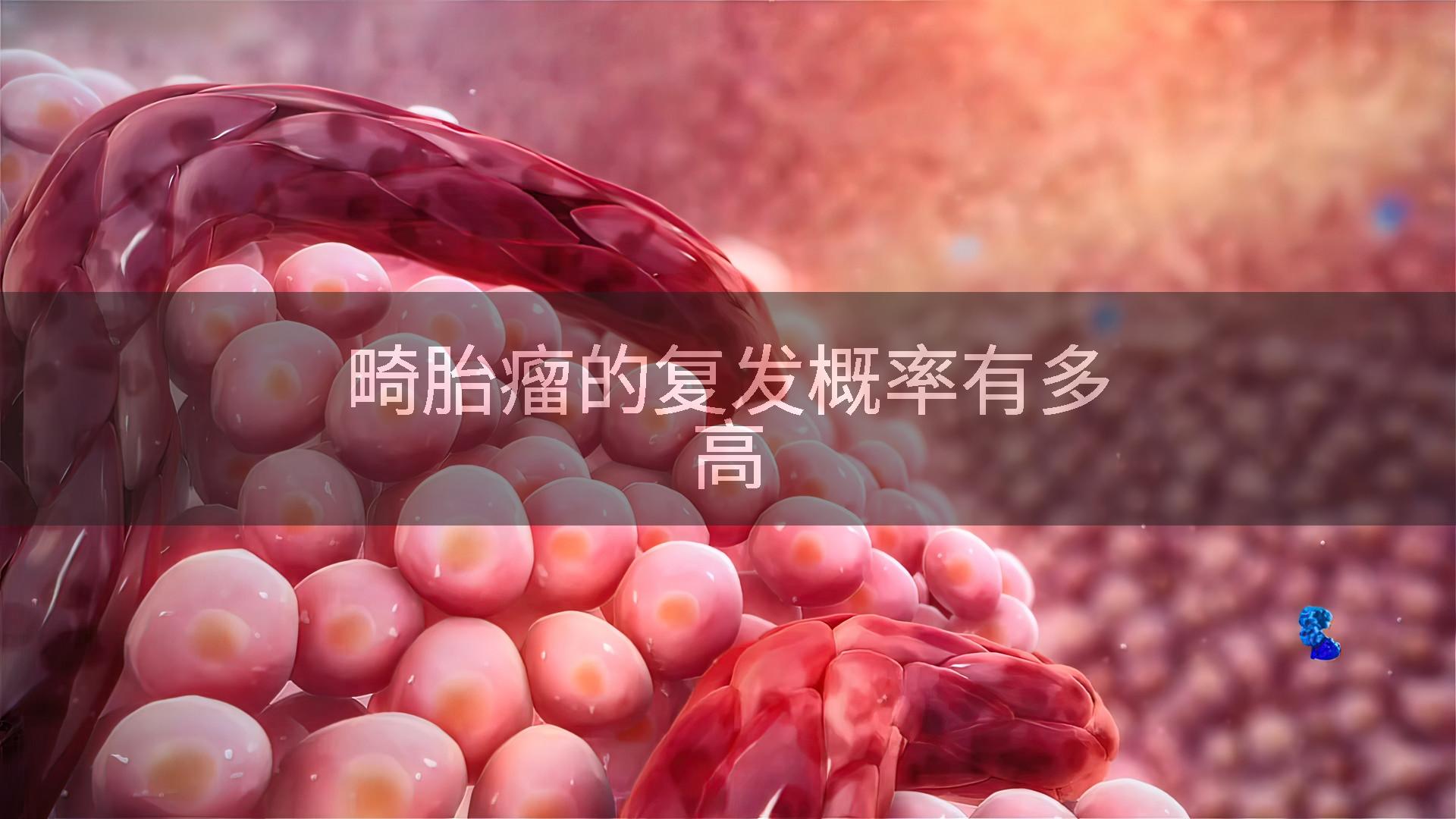 畸胎瘤的复发概率有多高