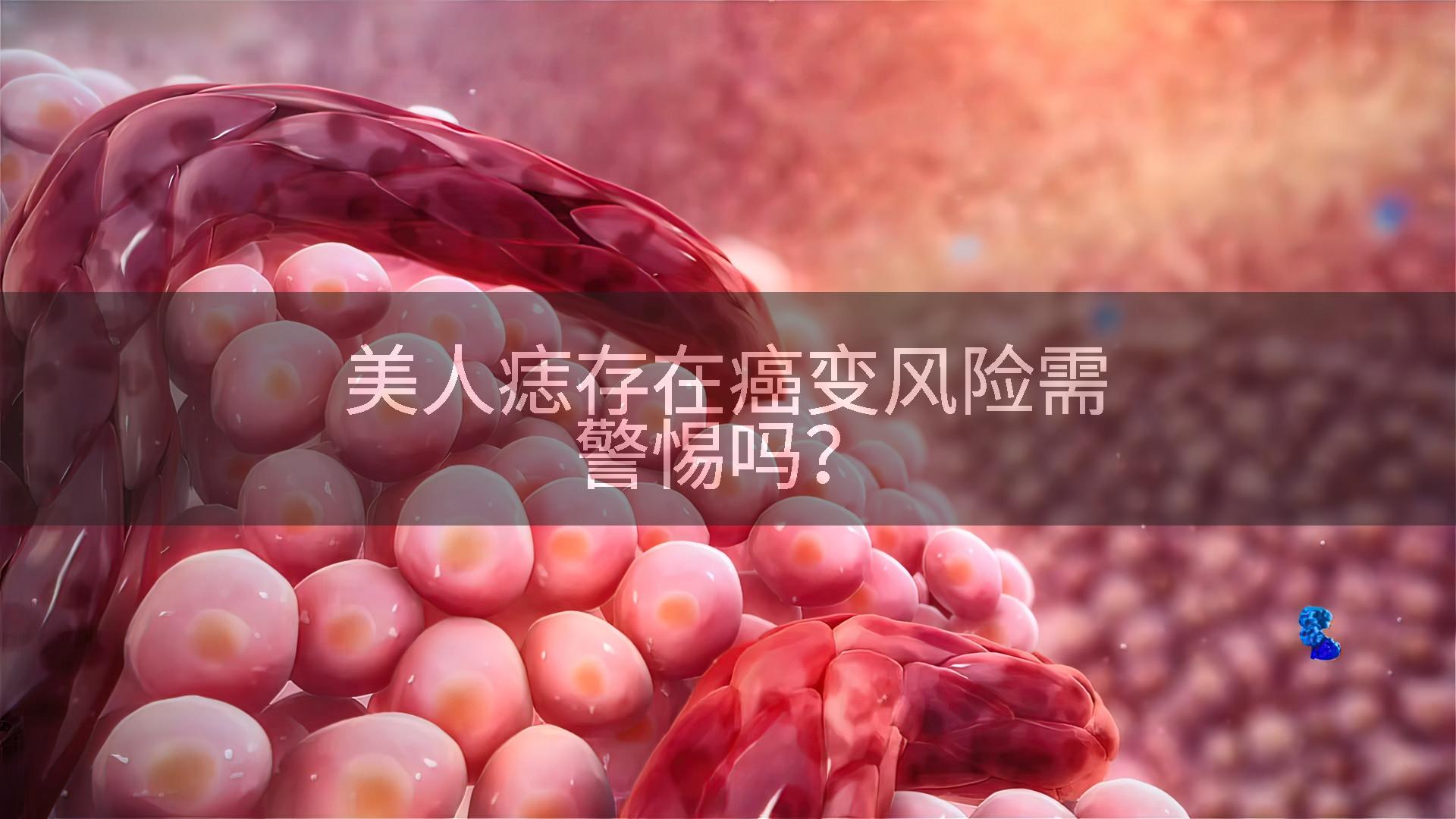 美人痣存在癌变风险需警惕吗?