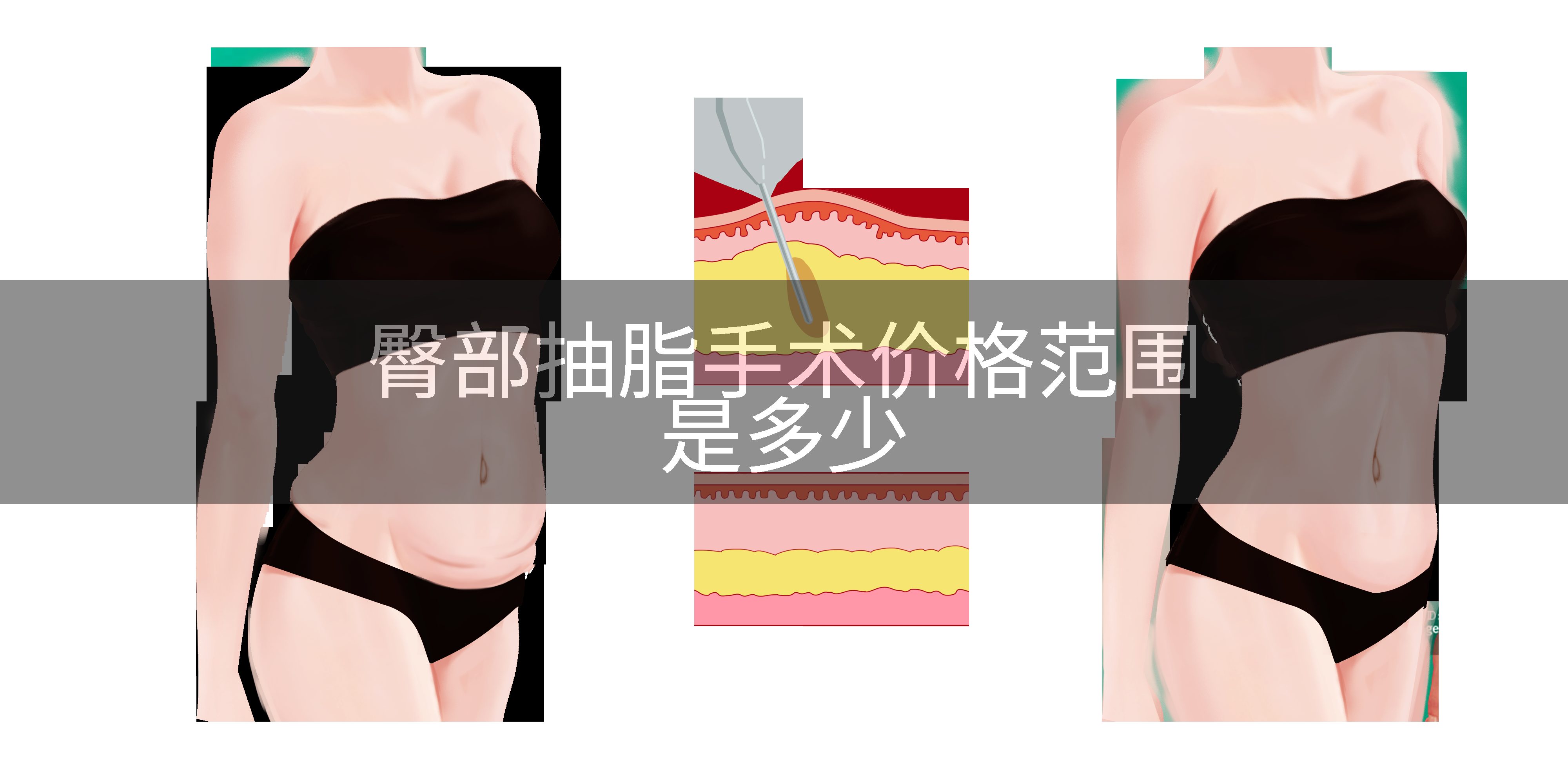 臀部抽脂手术价格范围是多少
