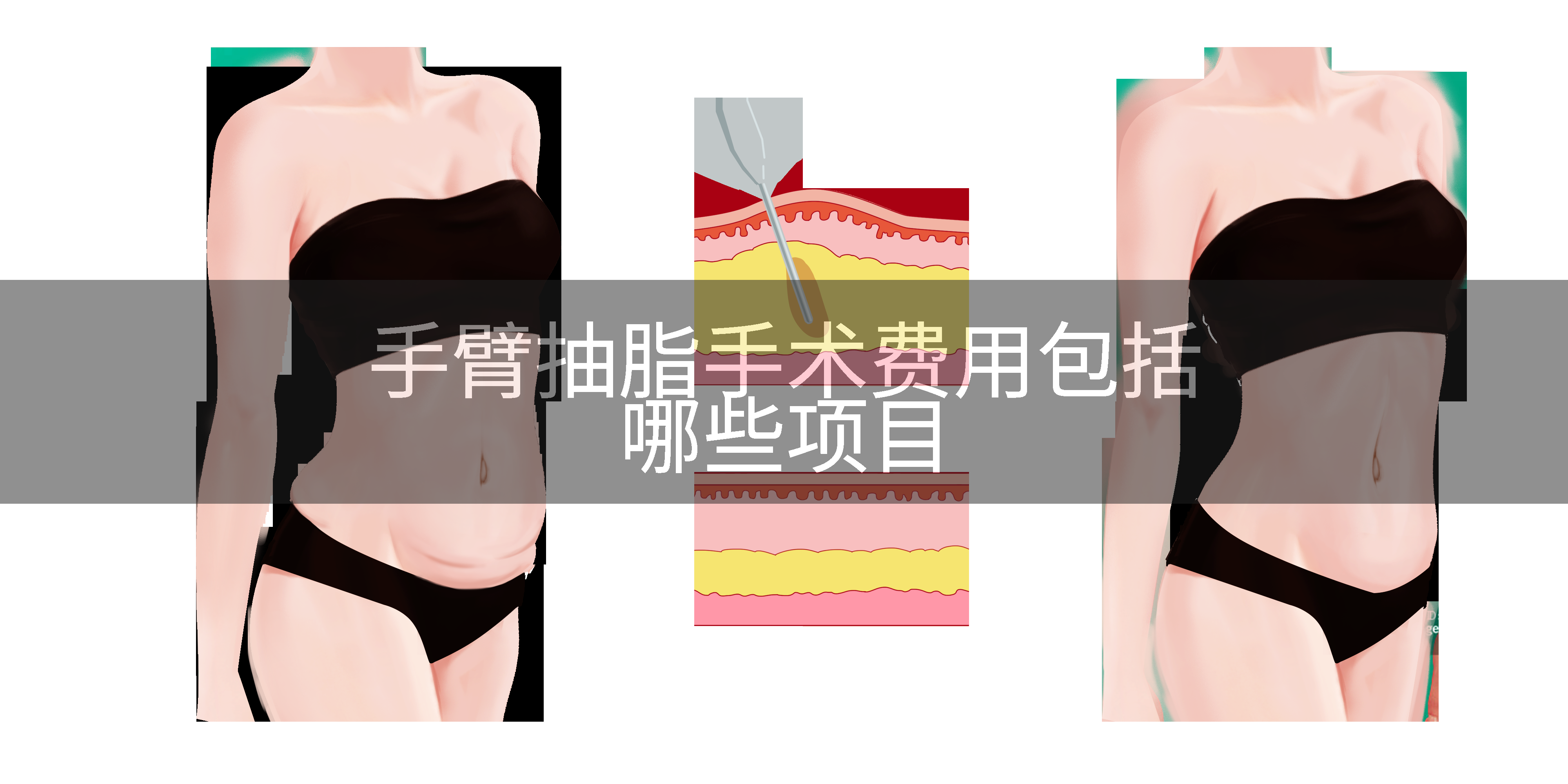 手臂抽脂手术费用包括哪些项目