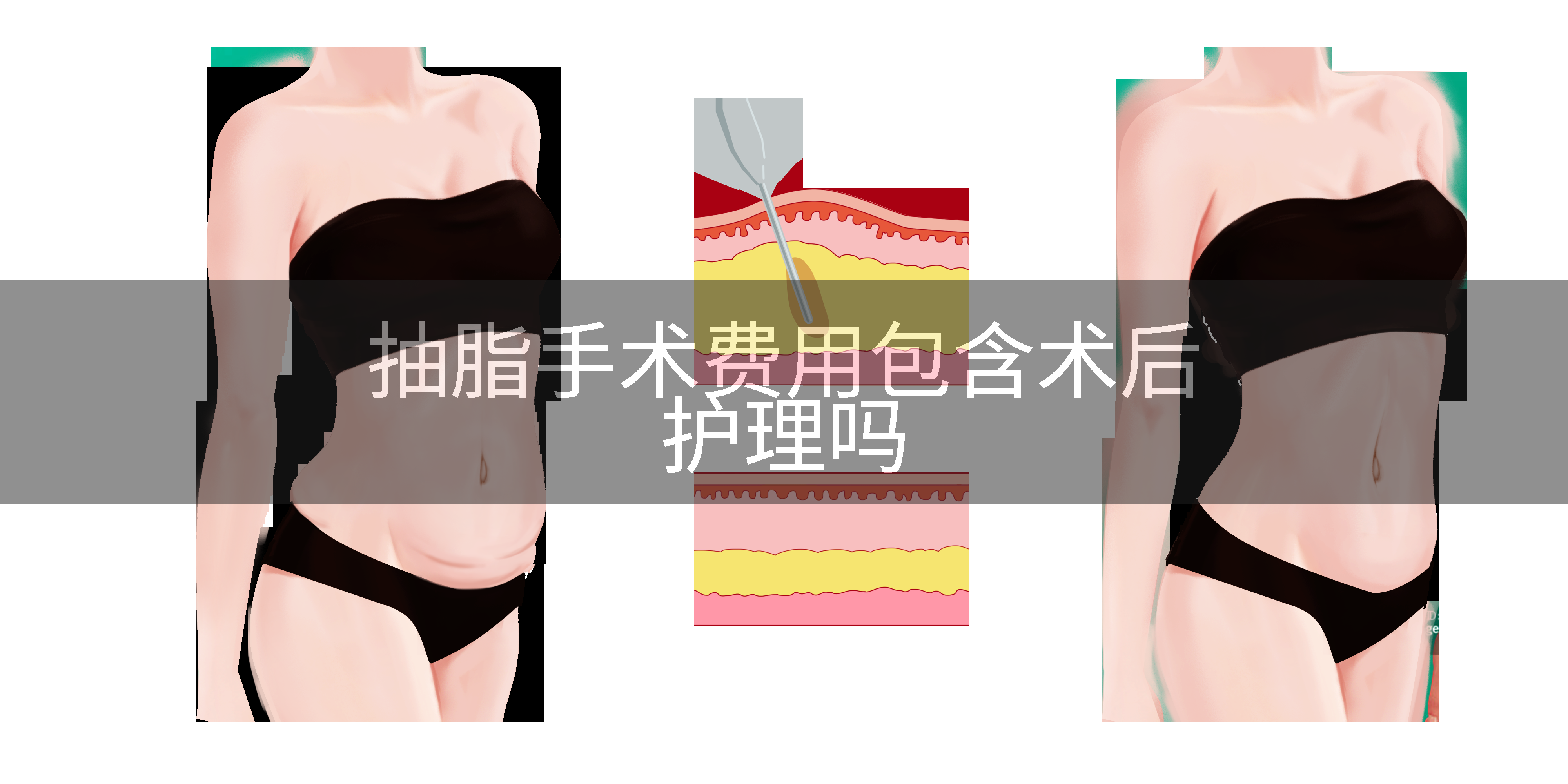 抽脂手术费用包含术后护理吗