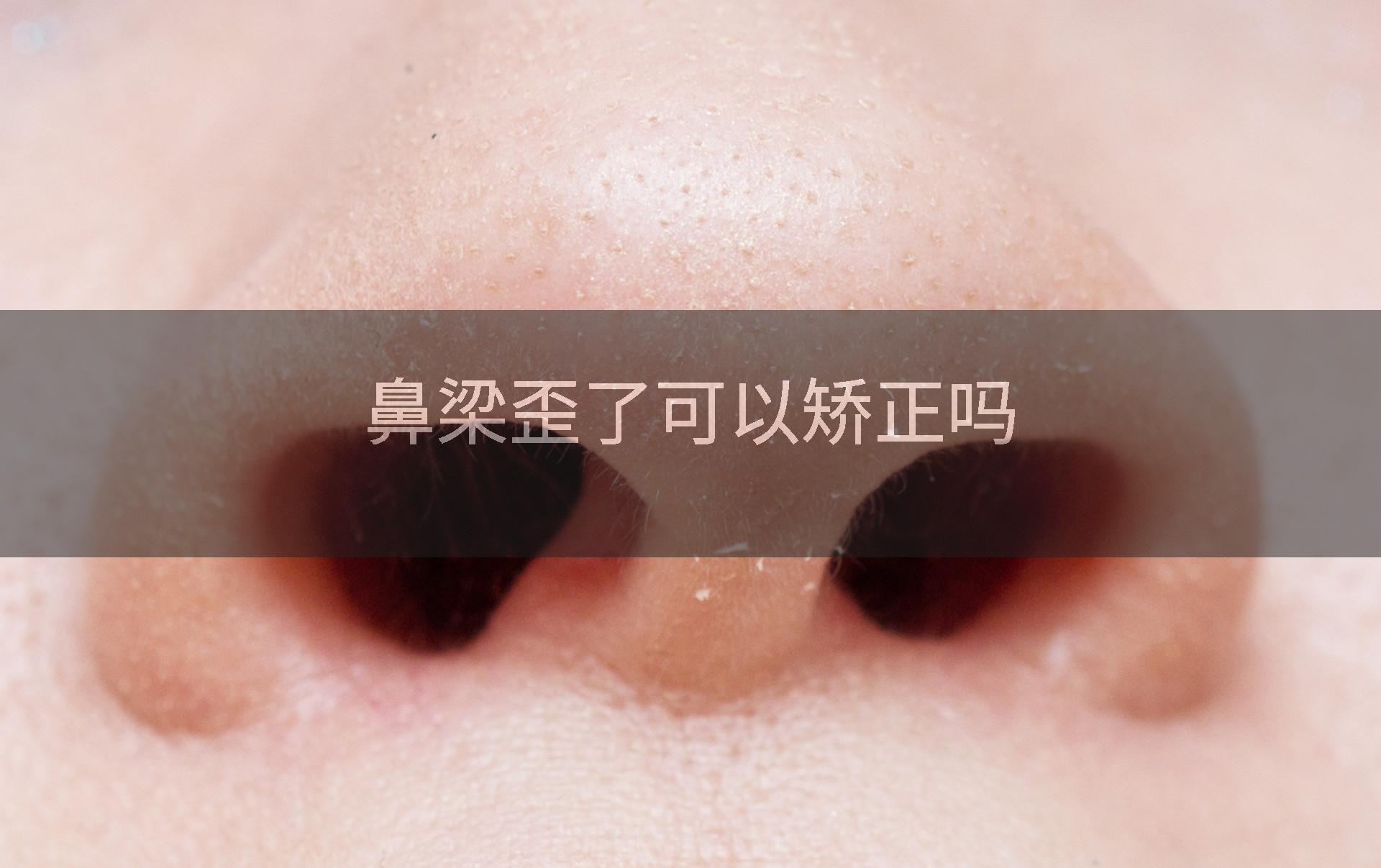 鼻梁歪了可以矫正吗