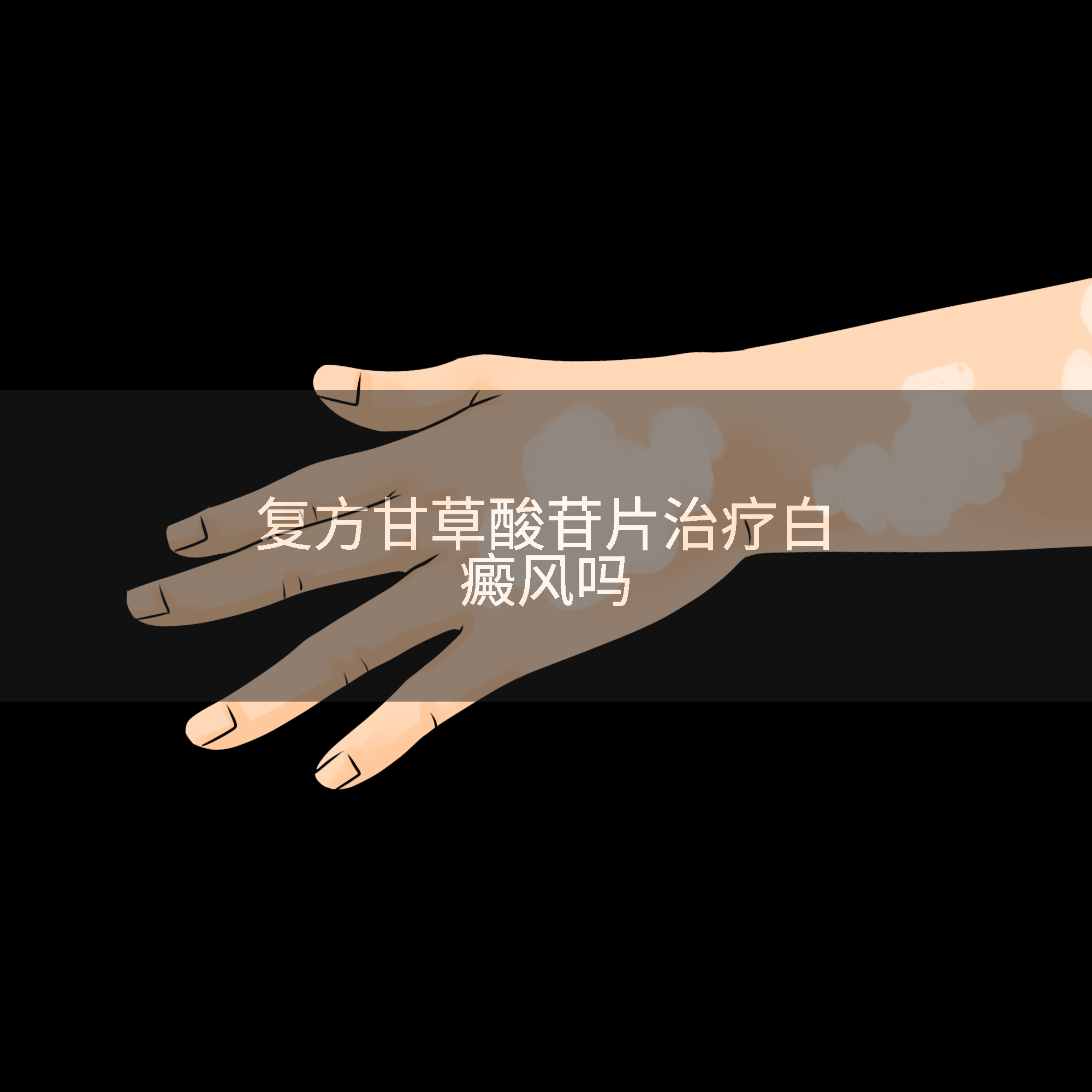 复方甘草酸苷片治疗白癜风吗