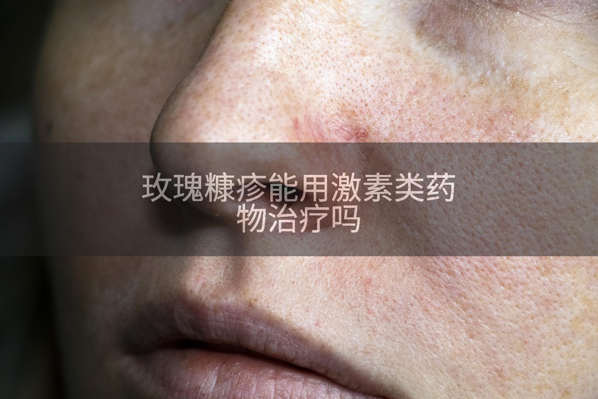 玫瑰糠疹能用激素类药物治疗吗
