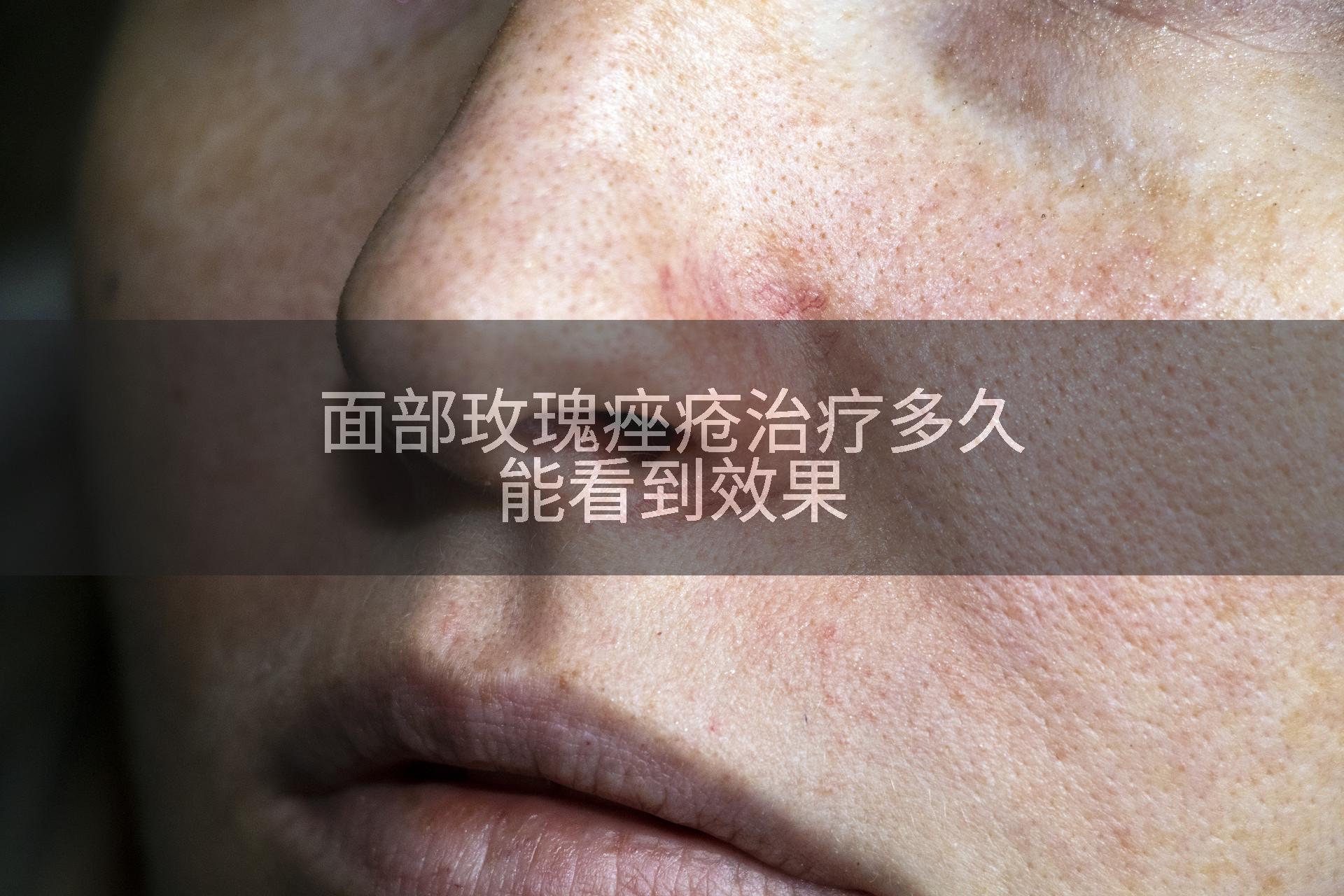 面部玫瑰痤疮治疗多久能看到效果