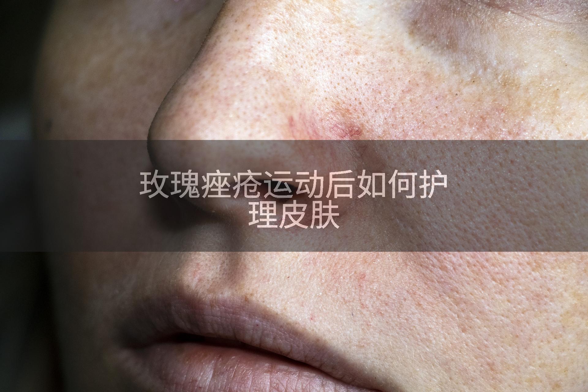 玫瑰痤疮运动后如何护理皮肤