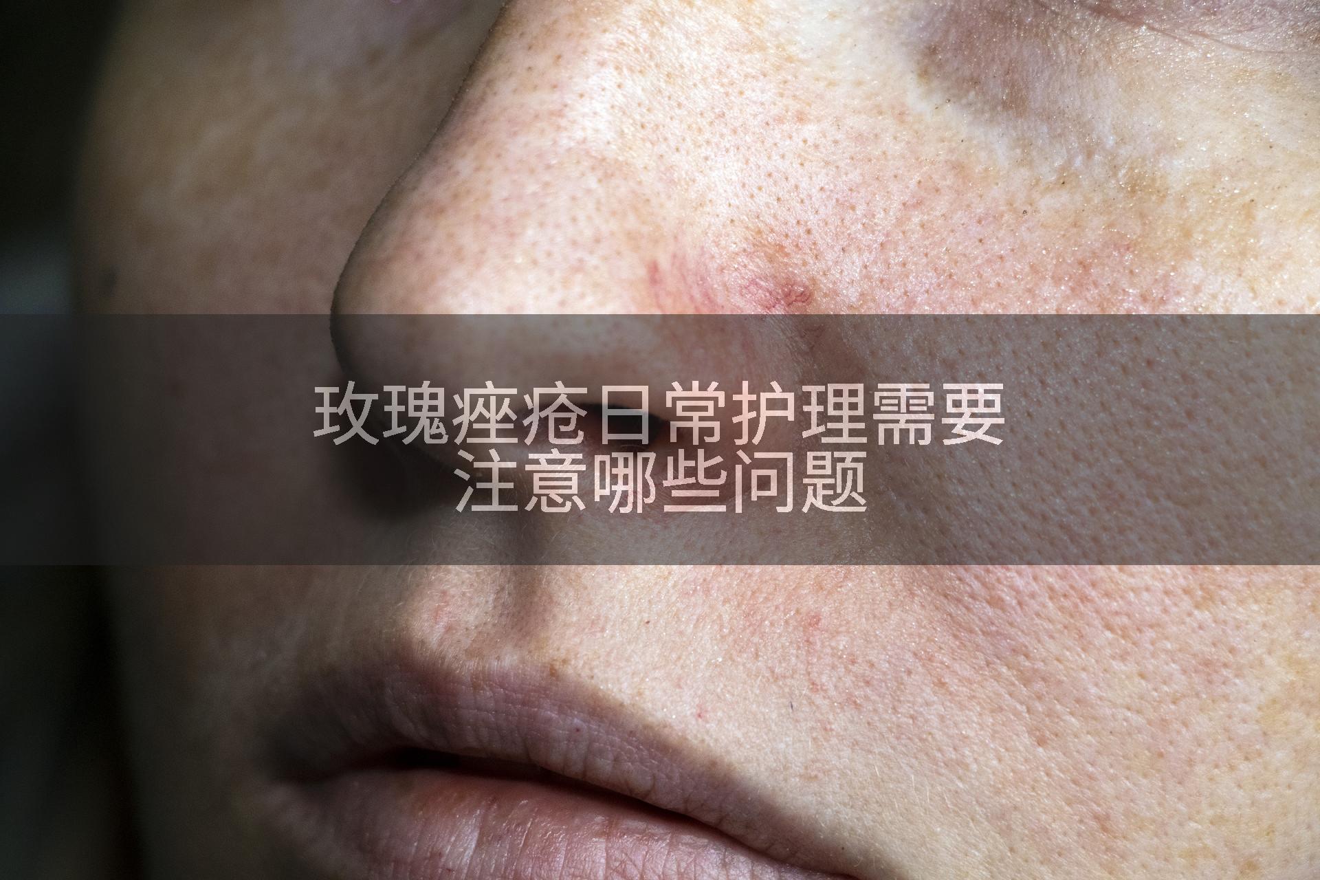 玫瑰痤疮日常护理需要注意哪些问题