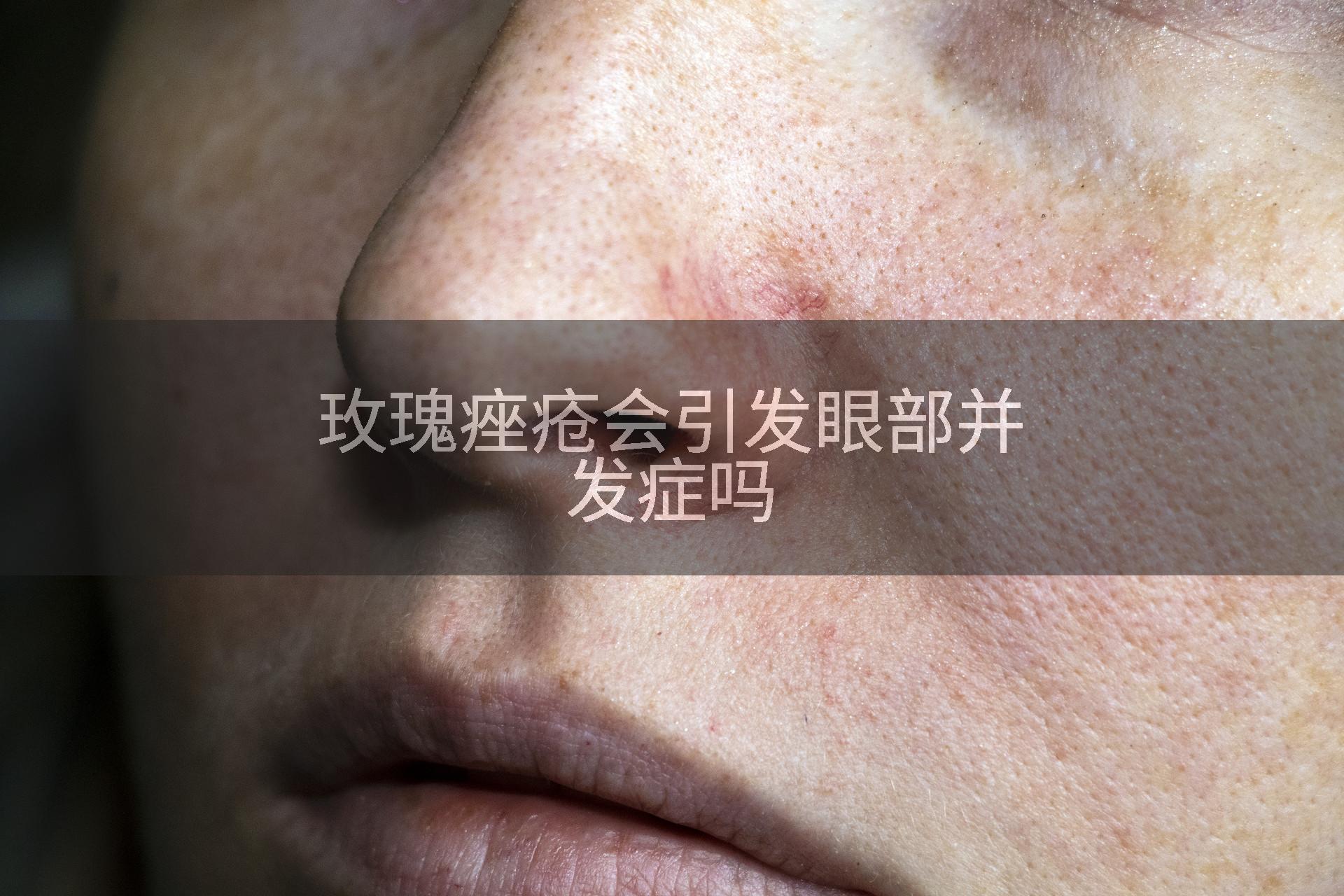 玫瑰痤疮会引发眼部并发症吗