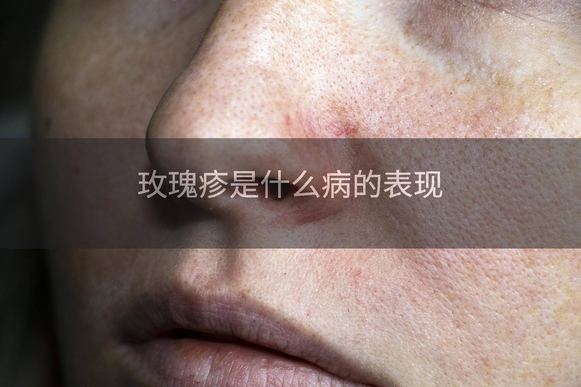 玫瑰疹是什么病的表现