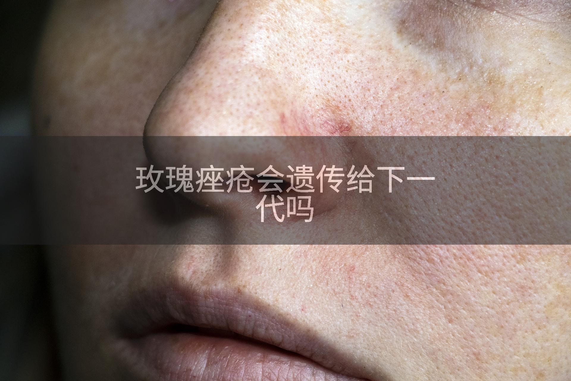 玫瑰痤疮会遗传给下一代吗