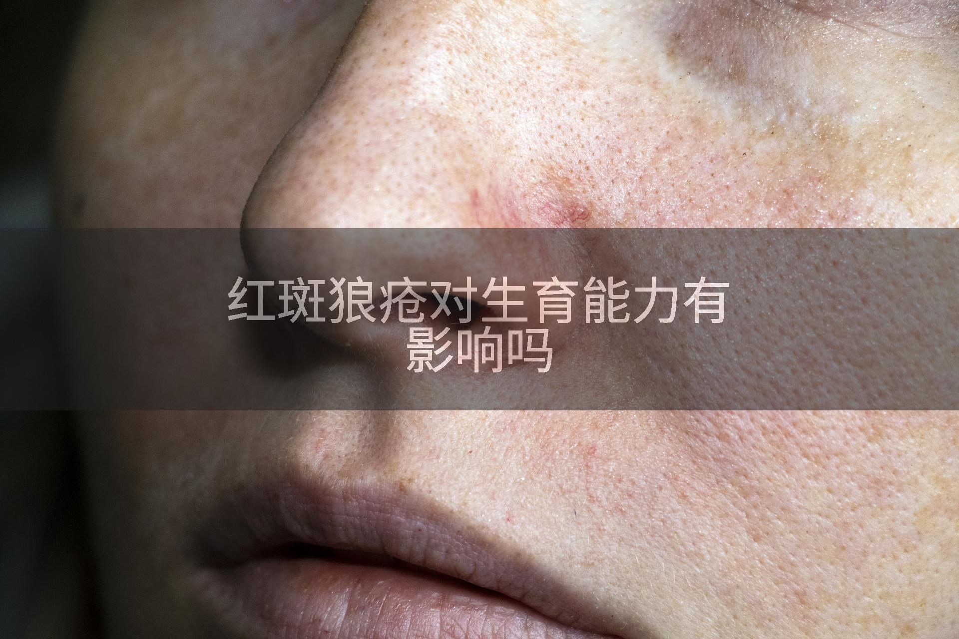 红斑狼疮对生育能力有影响吗