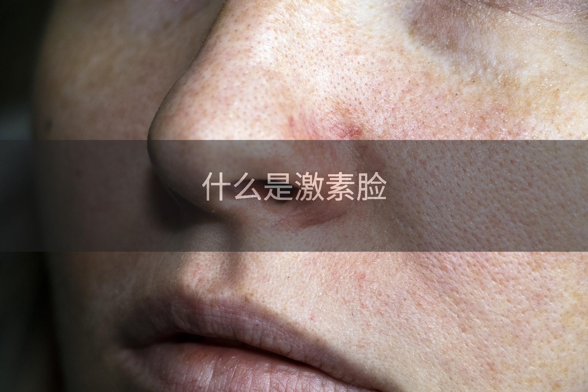 什么是激素脸