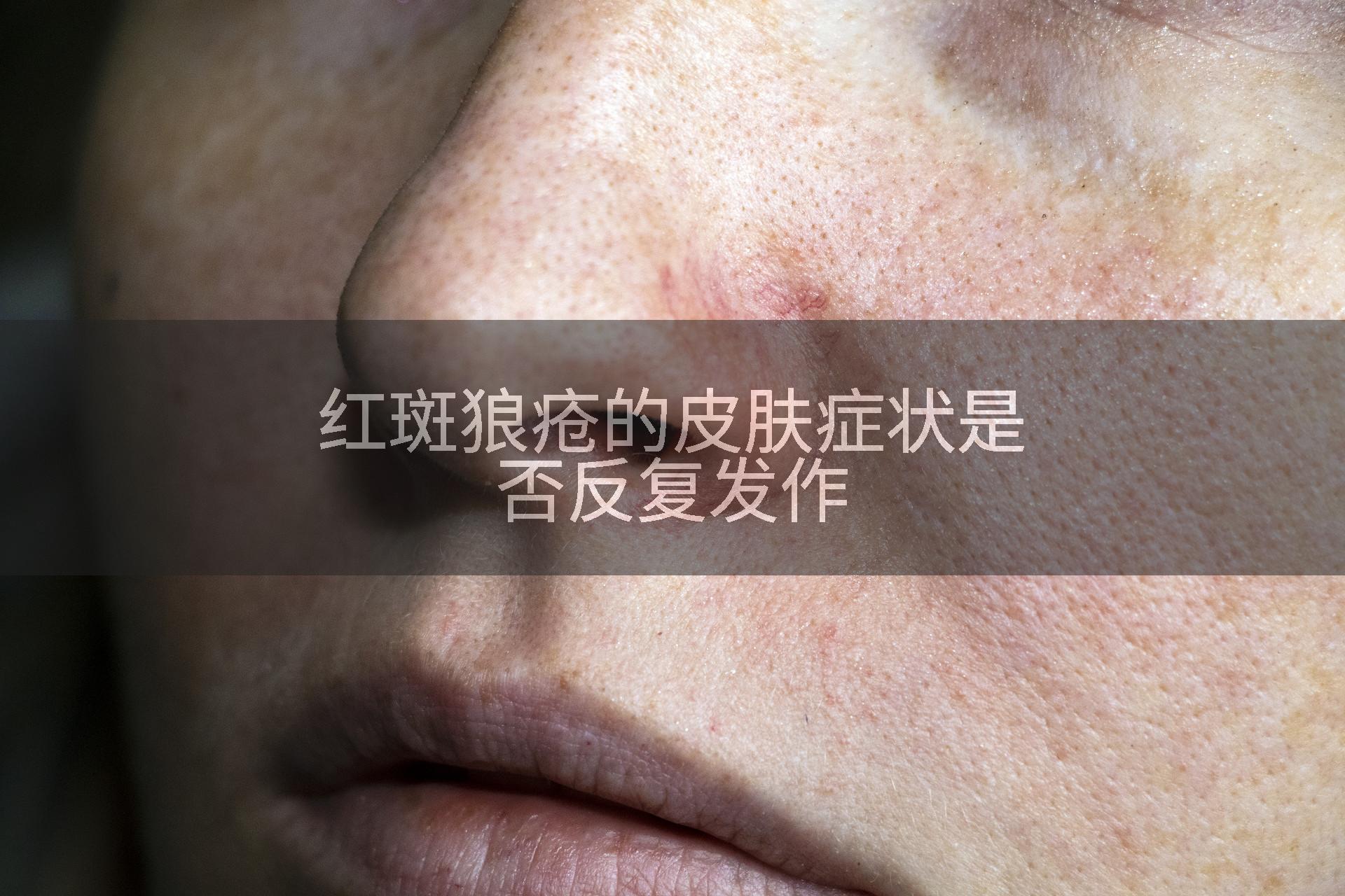 红斑狼疮的皮肤症状是否反复发作