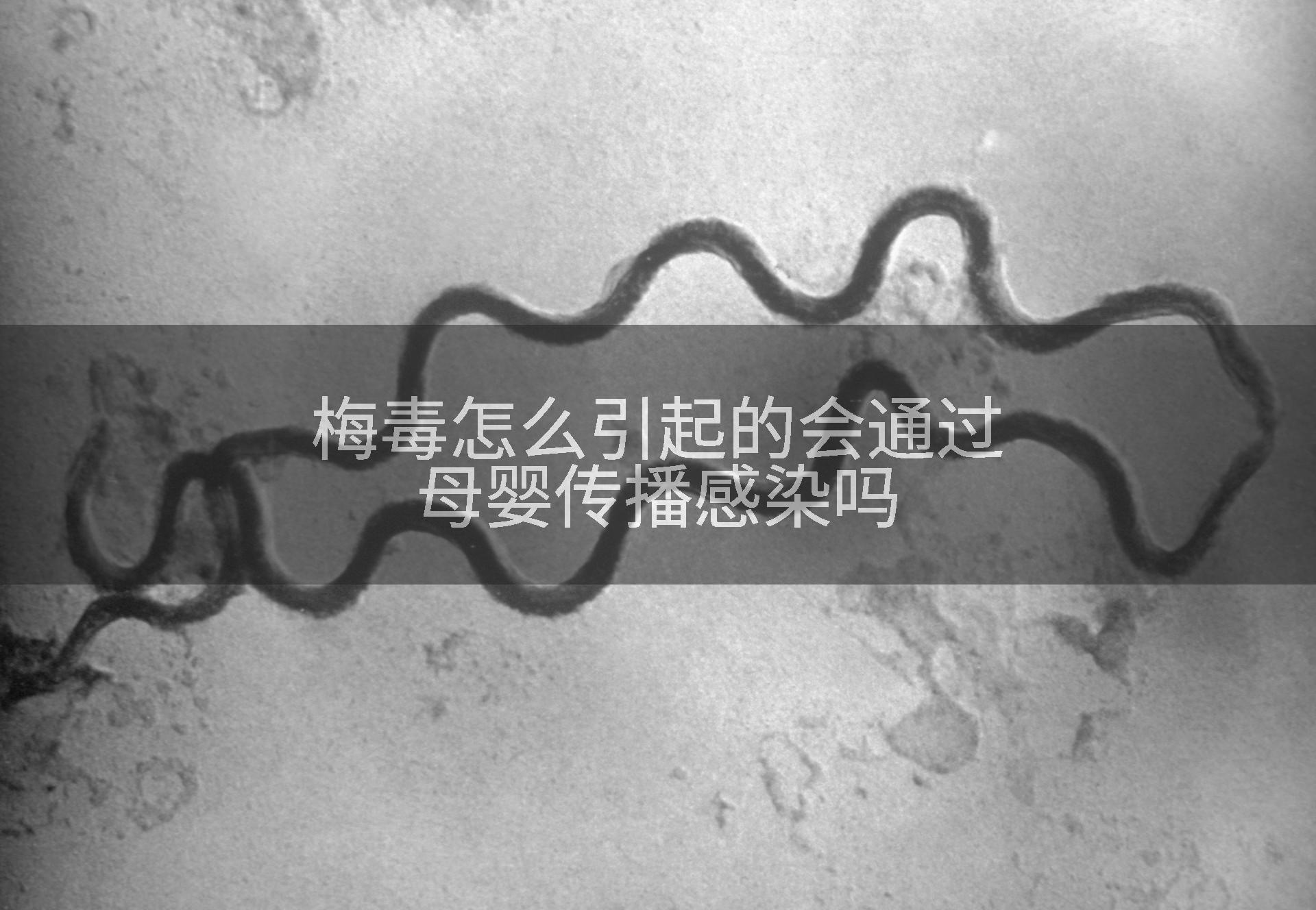 梅毒怎么引起的会通过母婴传播感染吗