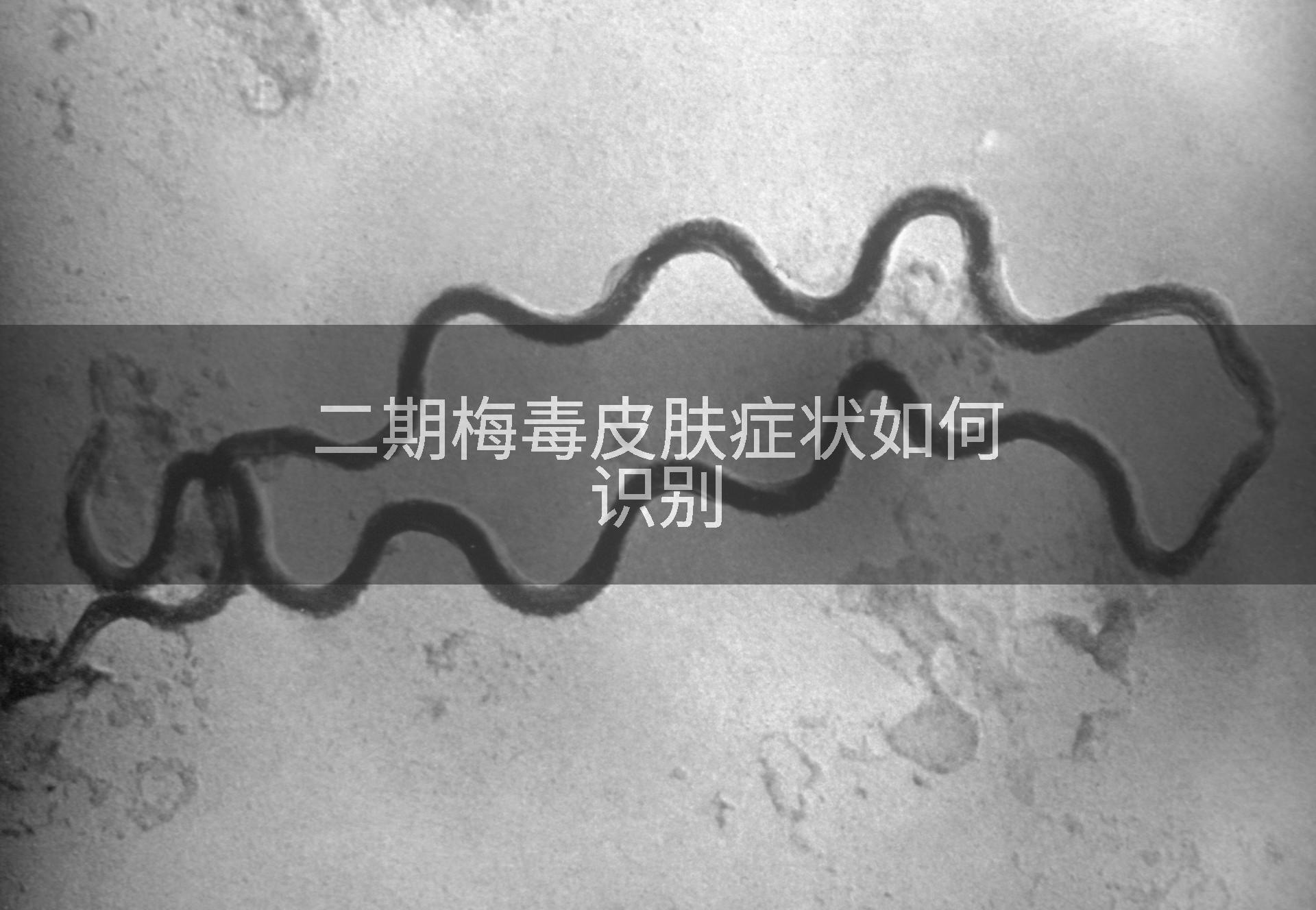 二期梅毒皮肤症状如何识别