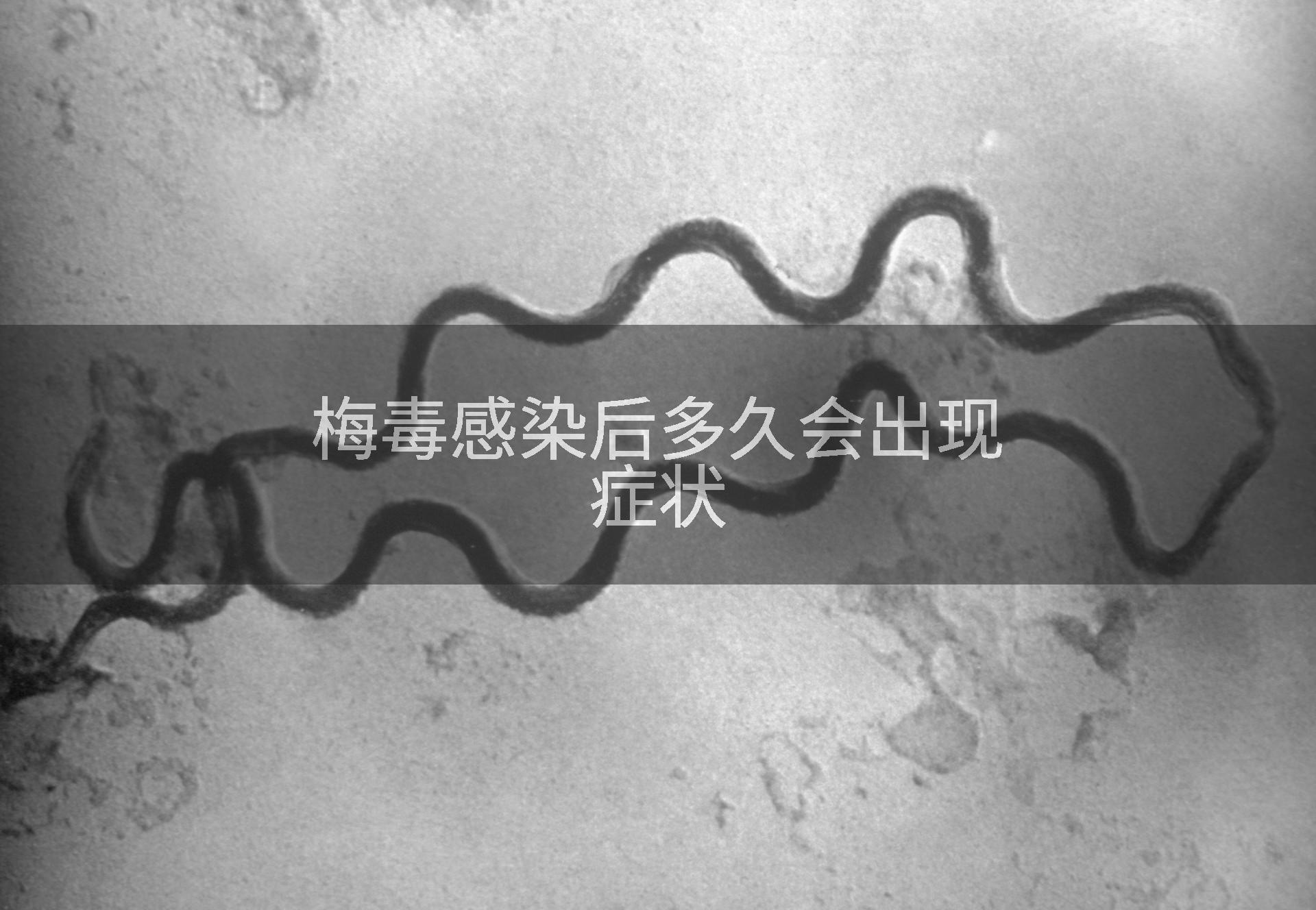 梅毒感染后多久会出现症状