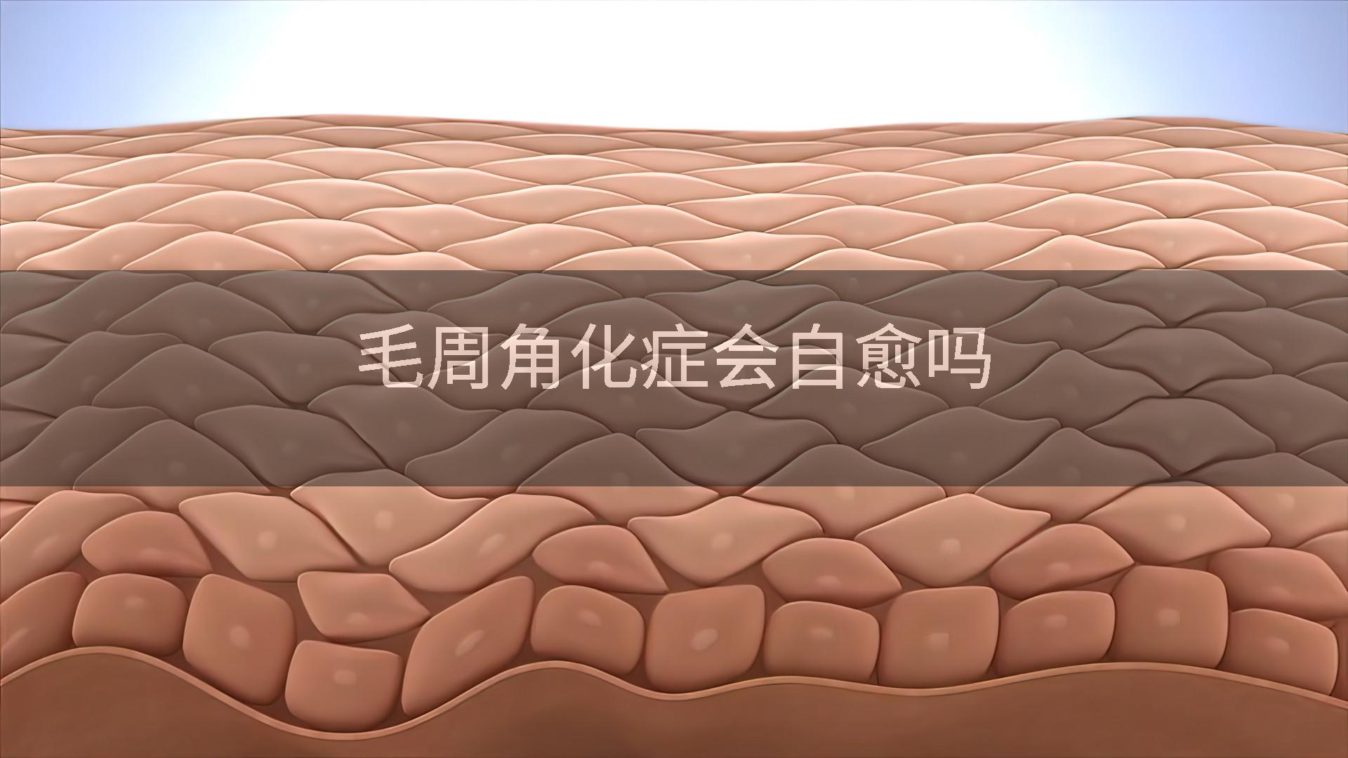 毛周角化症会自愈吗