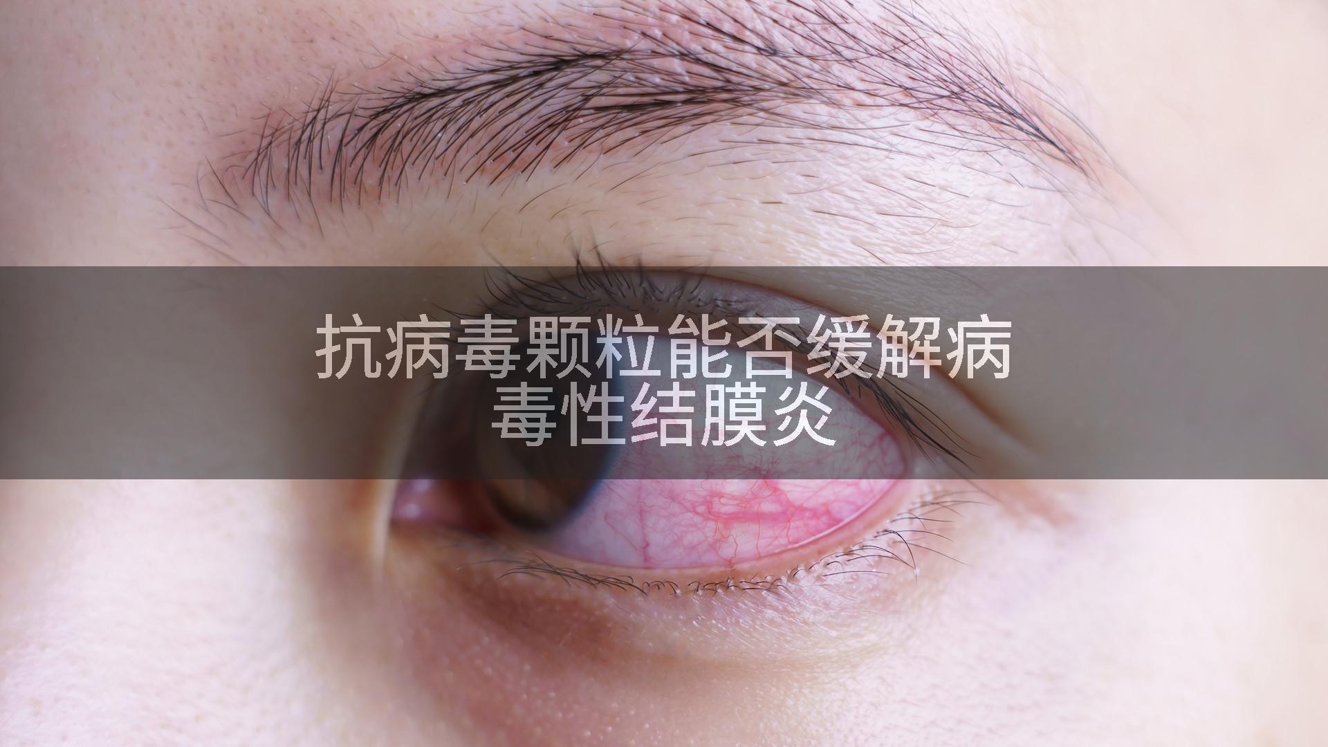 抗病毒颗粒能否缓解病毒性结膜炎